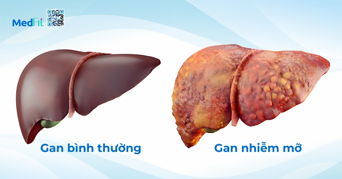 Béo phì: Nguyên nhân và phương pháp điều trị 6 béo phì có thể dẫn đến sự tích tụ mỡ trong gan (hình minh họa)