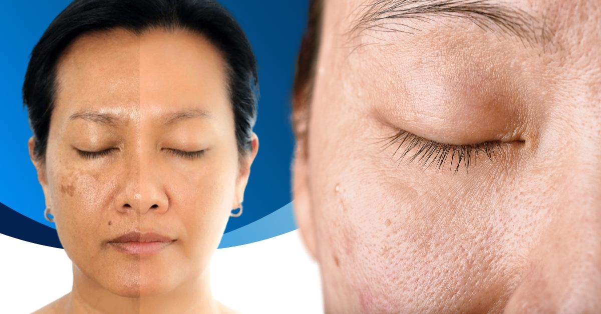 Người có một số tình trạng da khác như sần sùi, thô ráp, thiếu độ ẩm, giảm căng bóng, lỗ chân lông to, rạn da