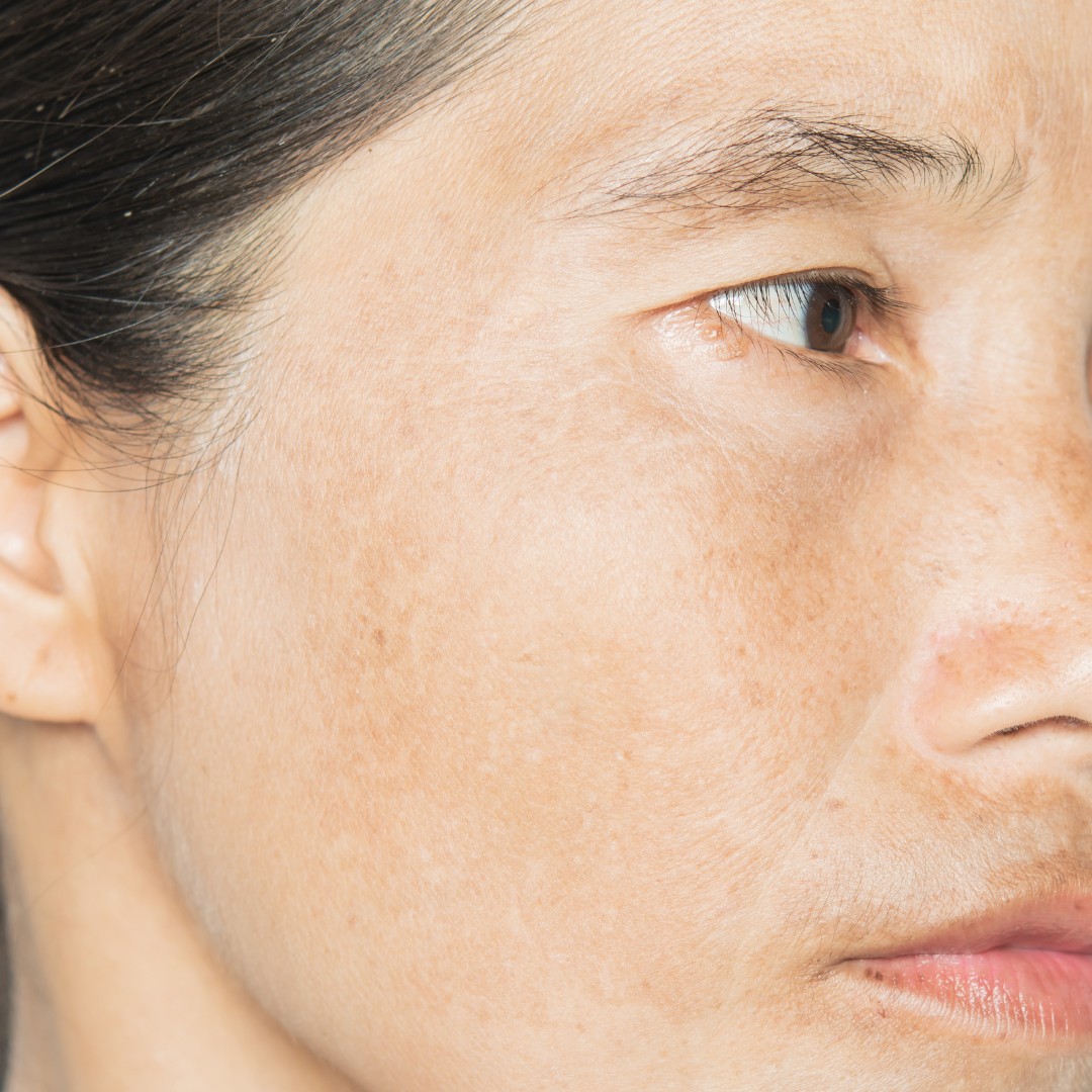 Rejuran Healer – Giải pháp trẻ hóa và tái tạo, phục hồi làn da 5