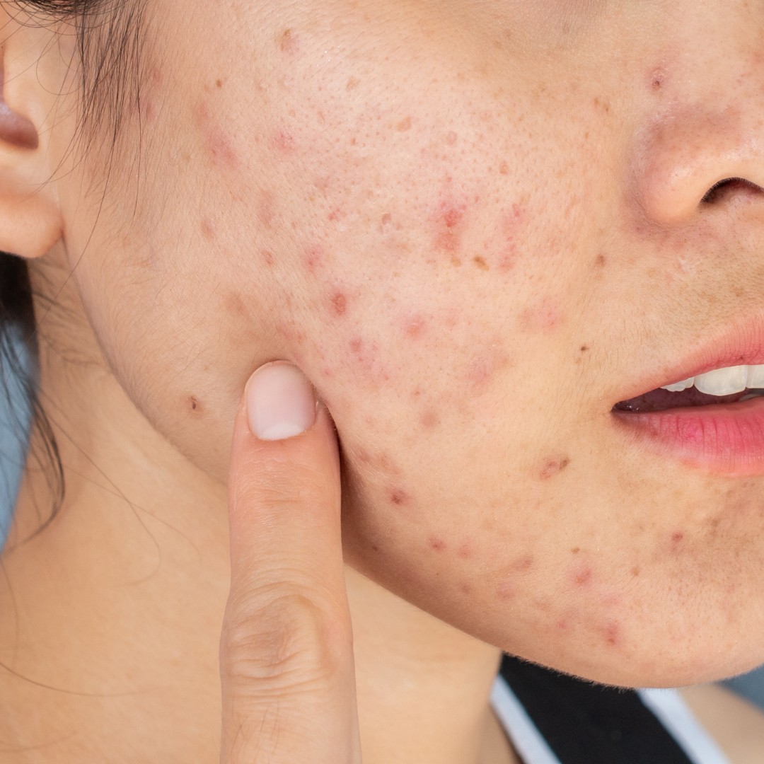 Rejuran Healer – Giải pháp trẻ hóa và tái tạo, phục hồi làn da 7