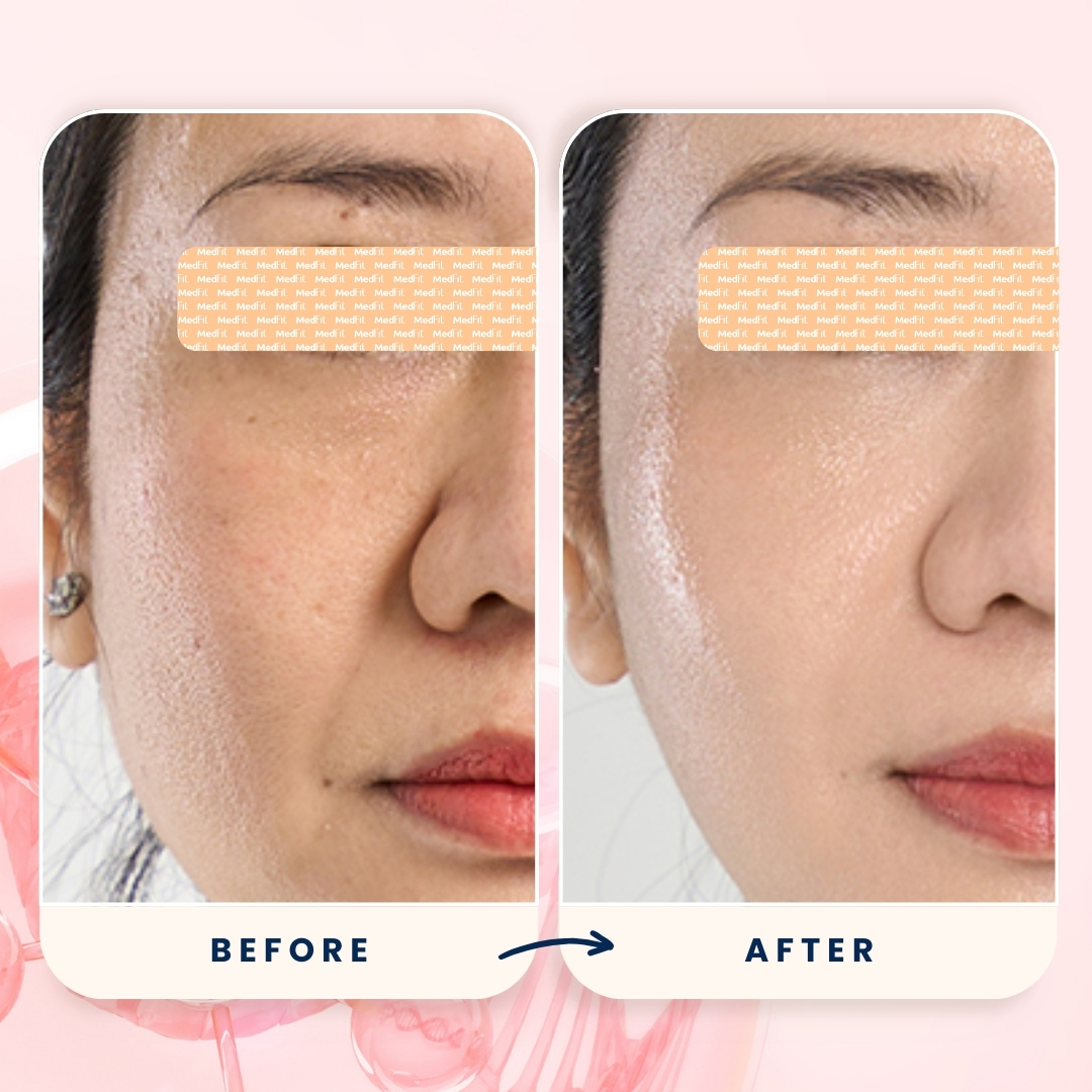 Hiệu quả tiêm Mesotherapy