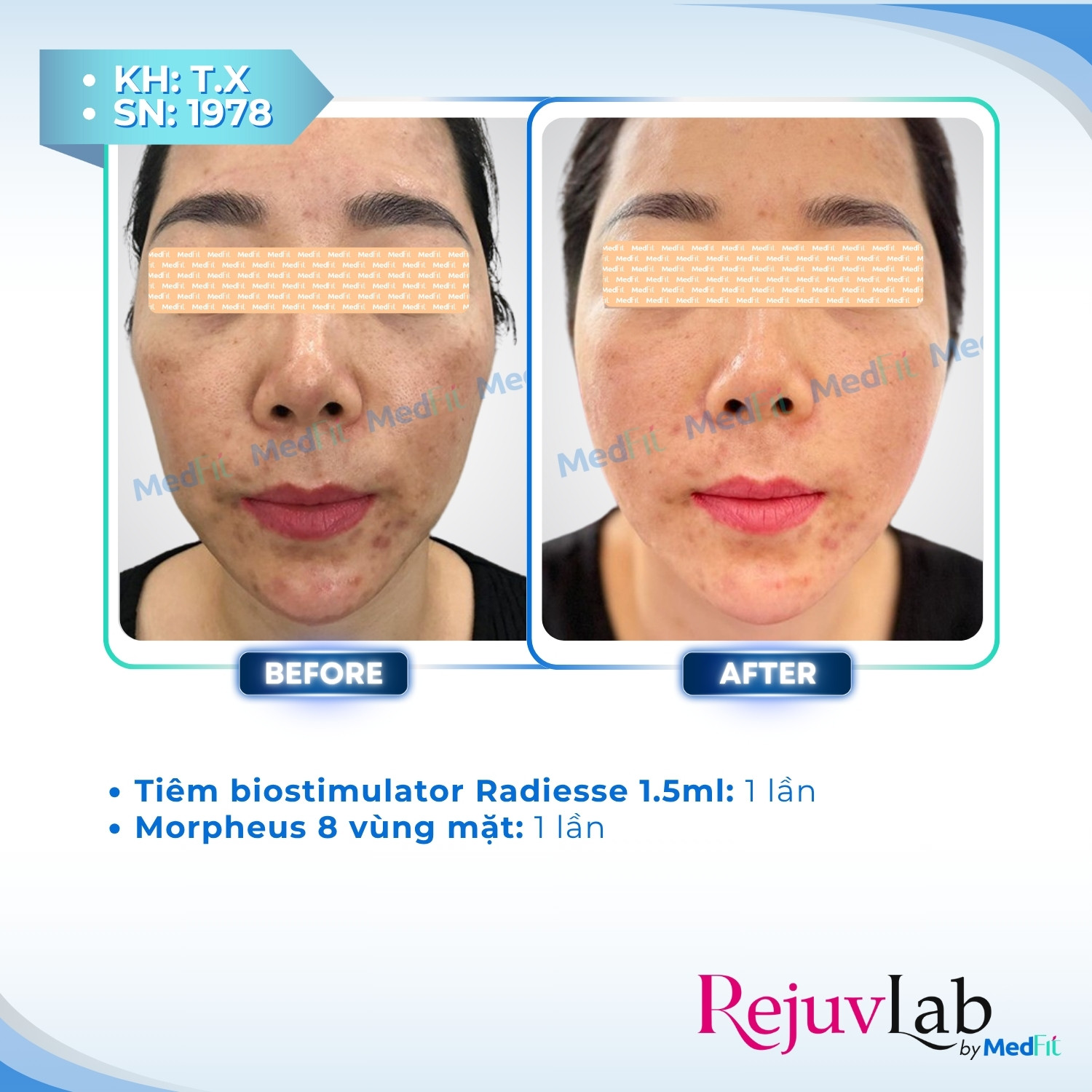 Radiesse – Tái tạo làn da và lấy lại nét đẹp tươi trẻ 4