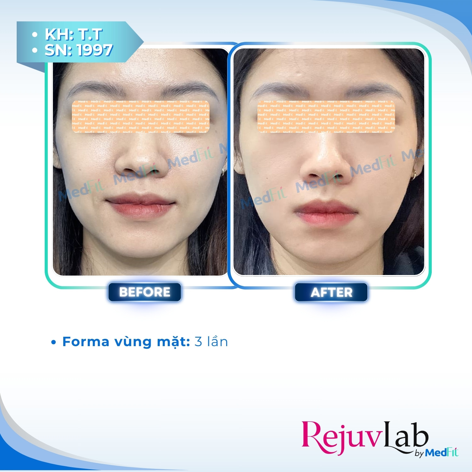 Forma - Công nghệ nâng cơ và làm săn chắc da không xâm lấn 2