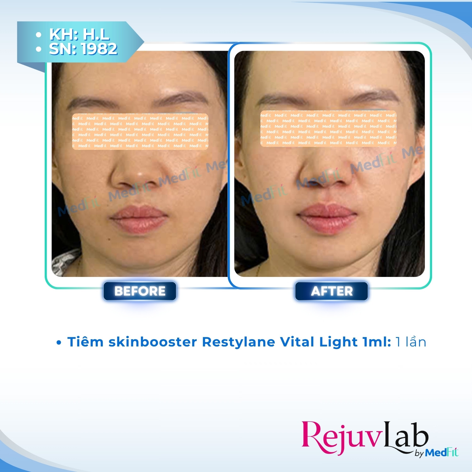 Restylane Vital Light – Tái tạo độ ẩm, cải thiện cấu trúc và trẻ hóa da tự nhiên 3