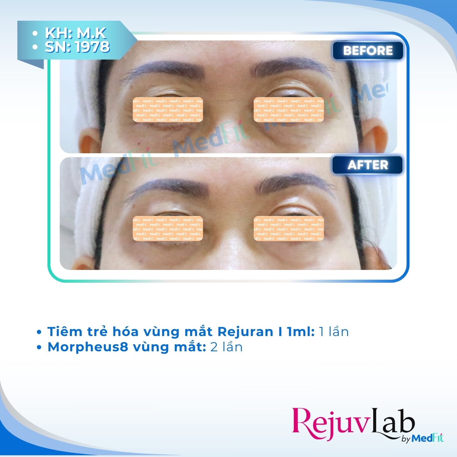Rejuran i – Giải pháp trẻ hóa da vùng mắt 4