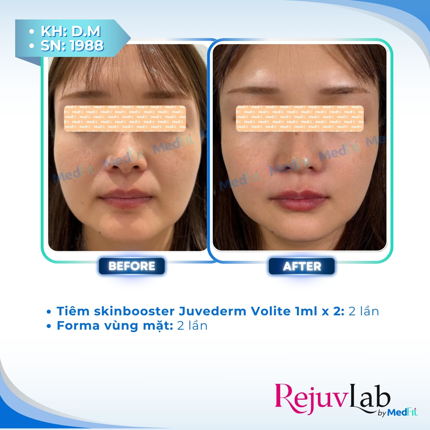 Juvederm® Volite – Kiến tạo khuôn mặt tươi trẻ và sắc nét 3