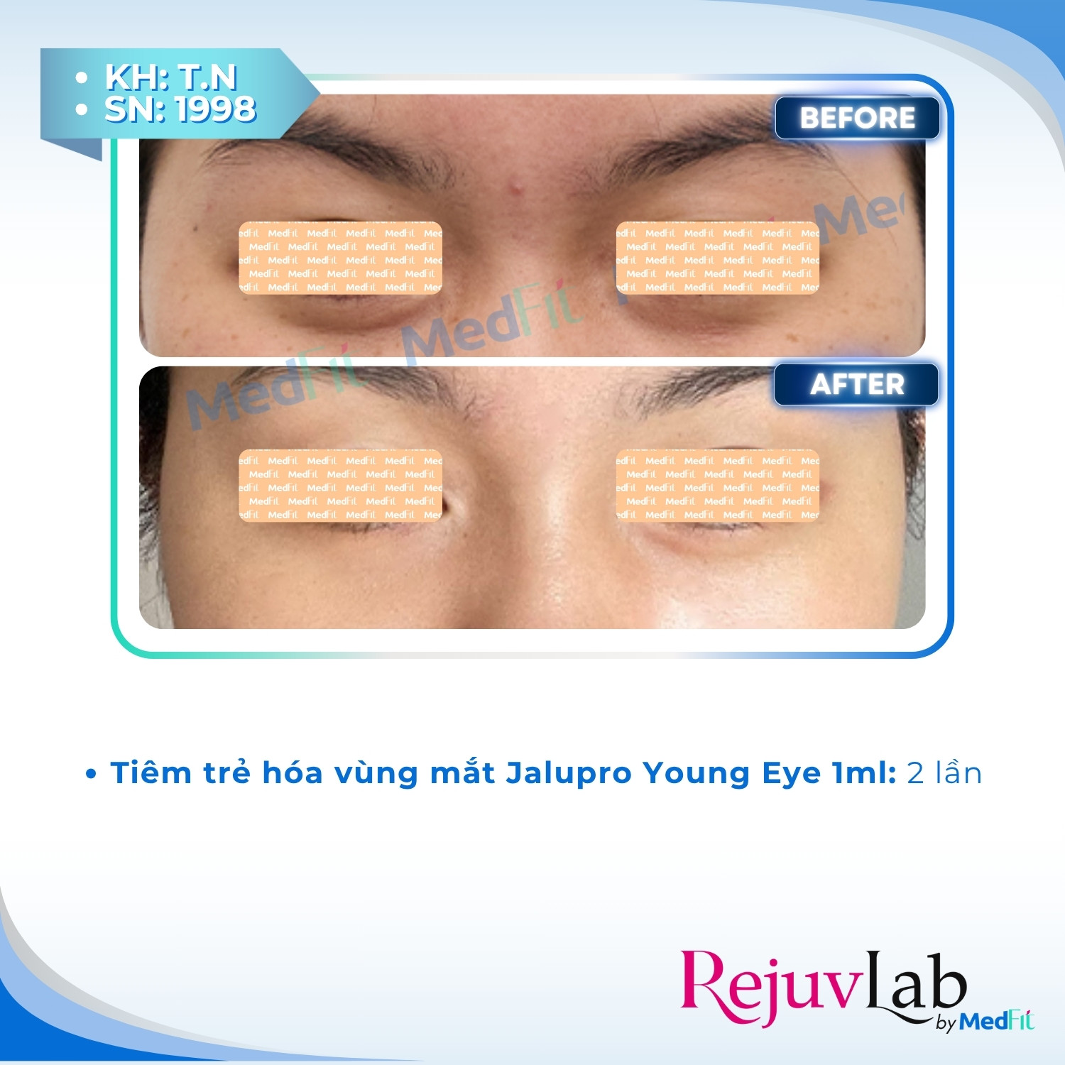Jalupro Young EYE - Giải pháp trẻ hóa toàn diện cho vùng mắt 3