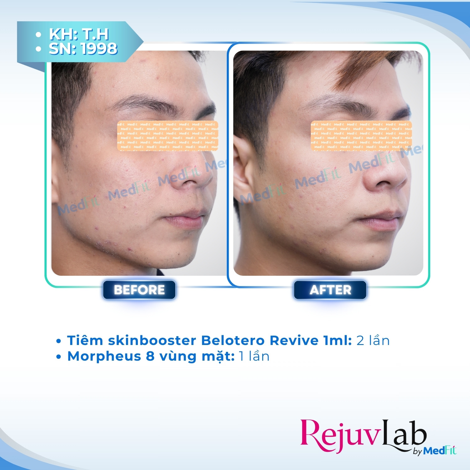 Belotero Revive - Công nghệ tái sinh làn da hoàn hảo 3