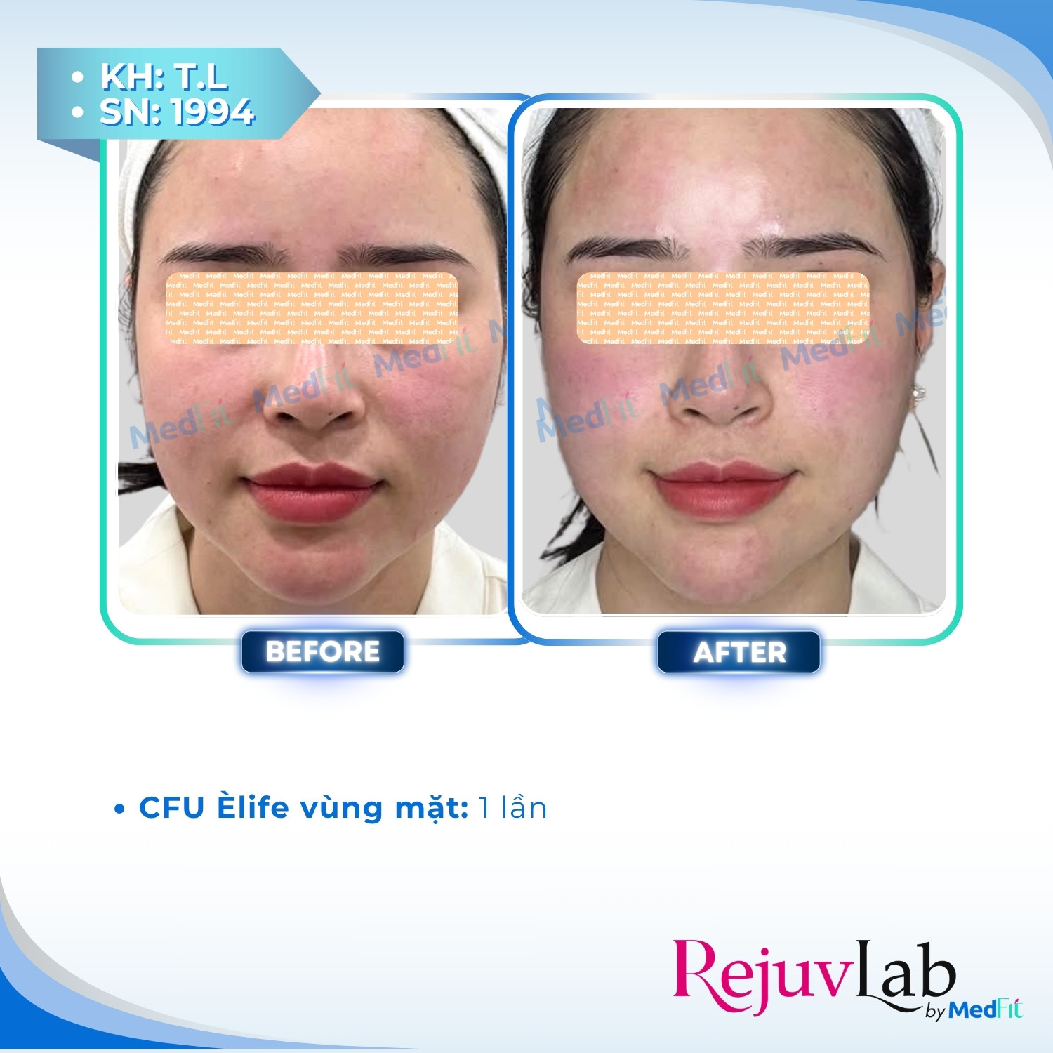 1 CFU Èlife – Công nghệ mới trong nâng cơ, trẻ hóa da và giảm mỡ toàn diện 4