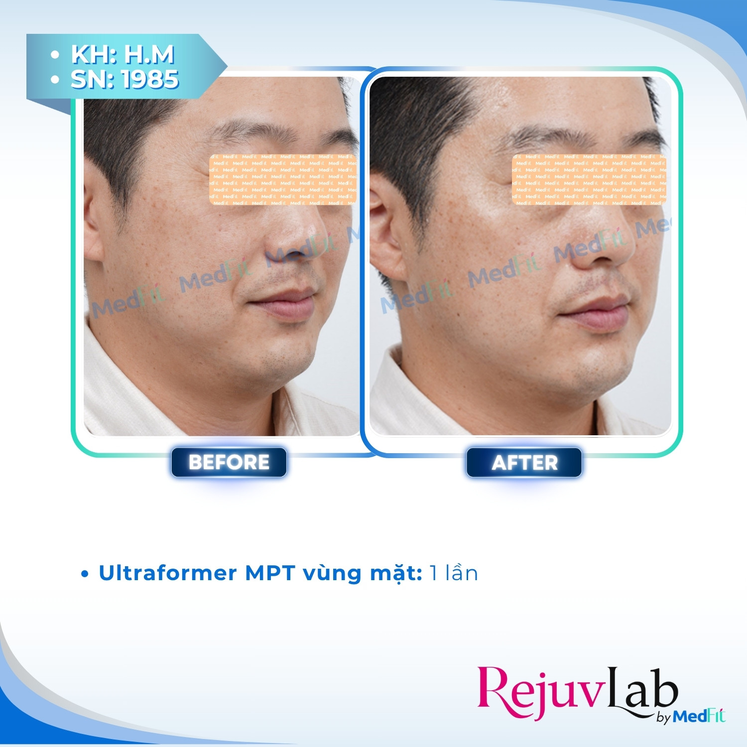 Ultraformer MPT – Đột phá mới trong công nghệ : nâng cơ, giảm mỡ, trẻ hóa da toàn diện 4