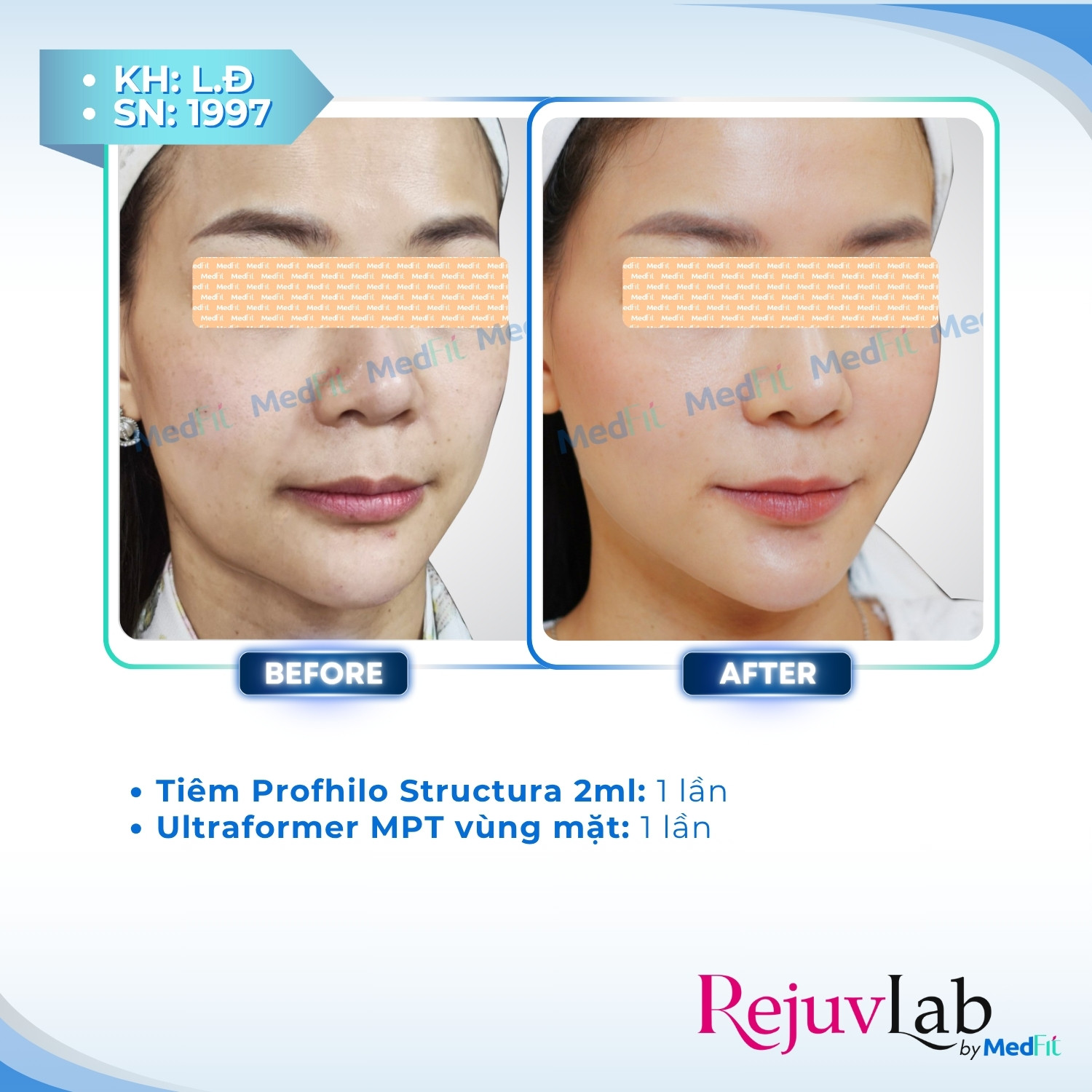 Profhilo Structura – Phương pháp cấp ẩm và trẻ hóa mô mỡ với hyaluronic acid 9