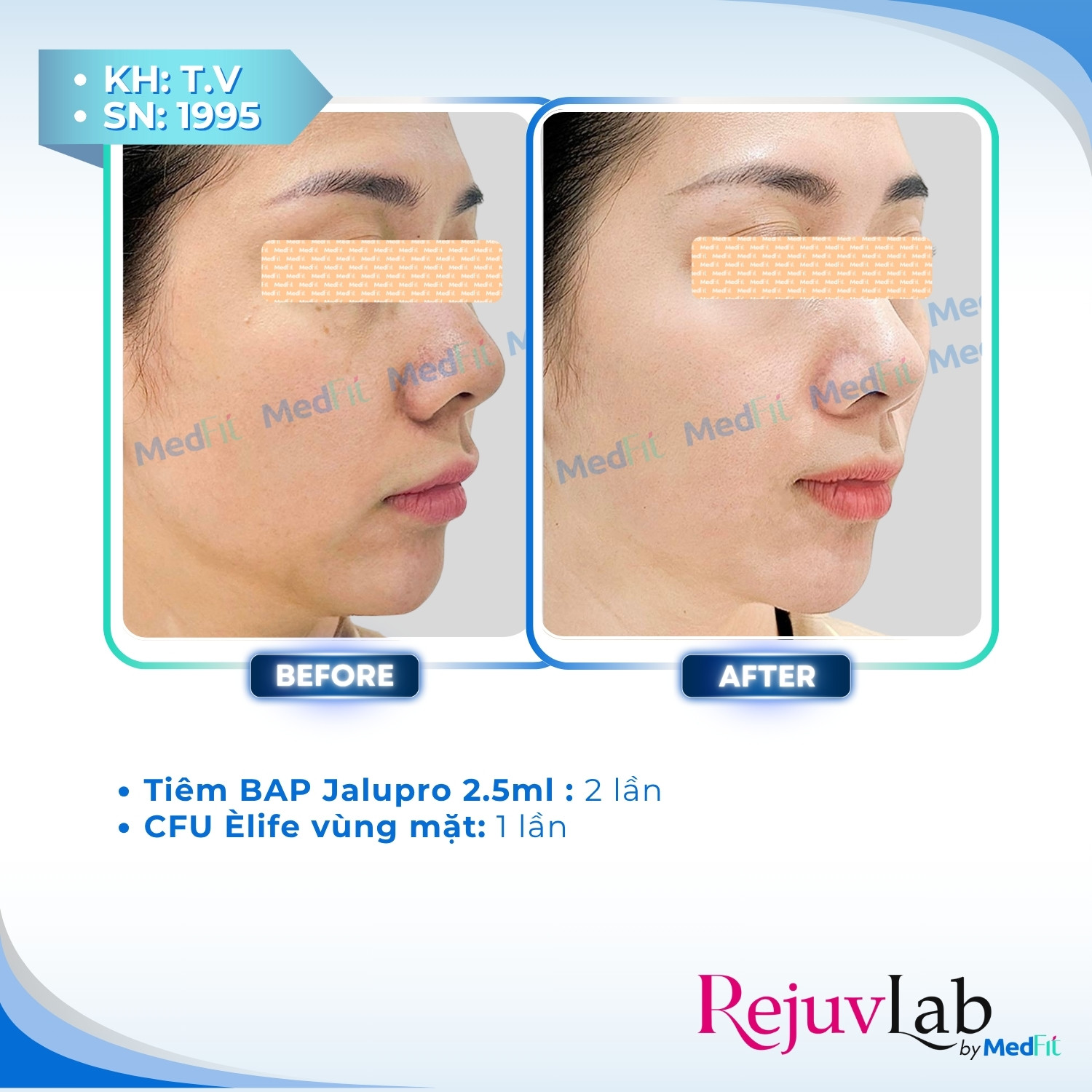 Tiêm B.A.P Jalupro – Phương pháp cấp ẩm và trẻ hóa, tái sinh làn da rạng ngời 4