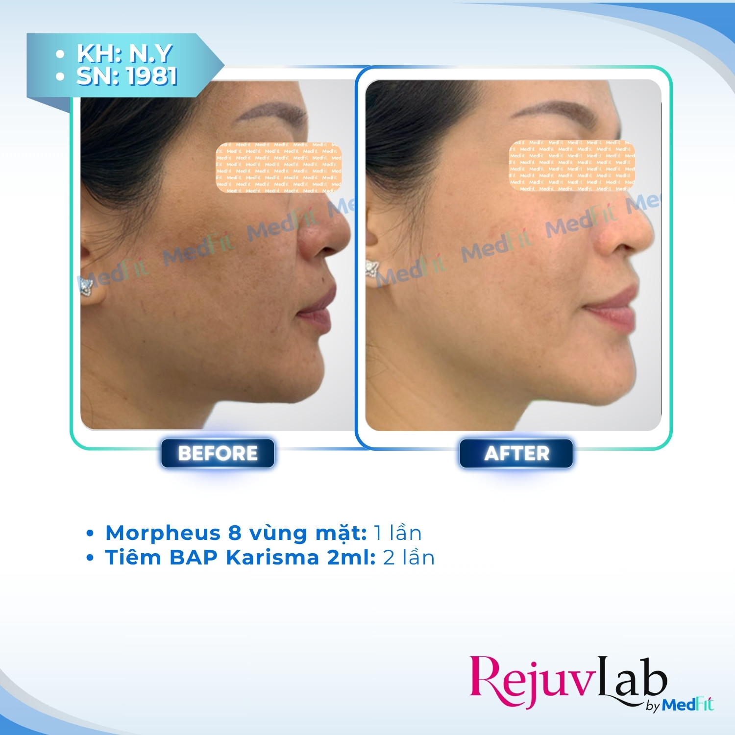 Nâng cơ và trẻ hóa da - căn chỉnh khuôn mặt 73