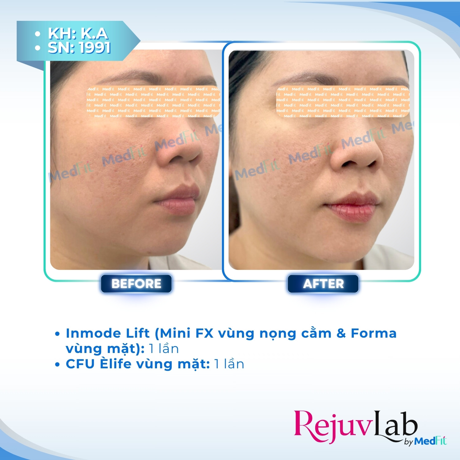 Giảm mỡ vùng mặt - trị nọng cằm 12