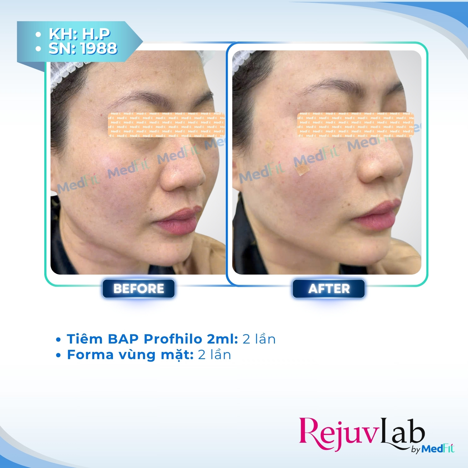 Nâng cơ và trẻ hóa da - căn chỉnh khuôn mặt 75
