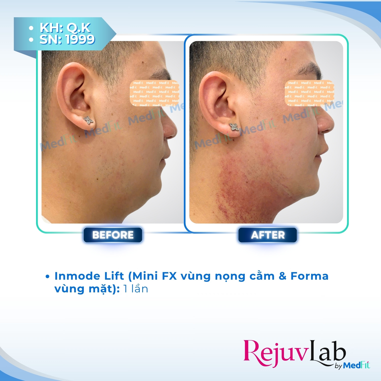 Giảm mỡ vùng mặt - trị nọng cằm 13