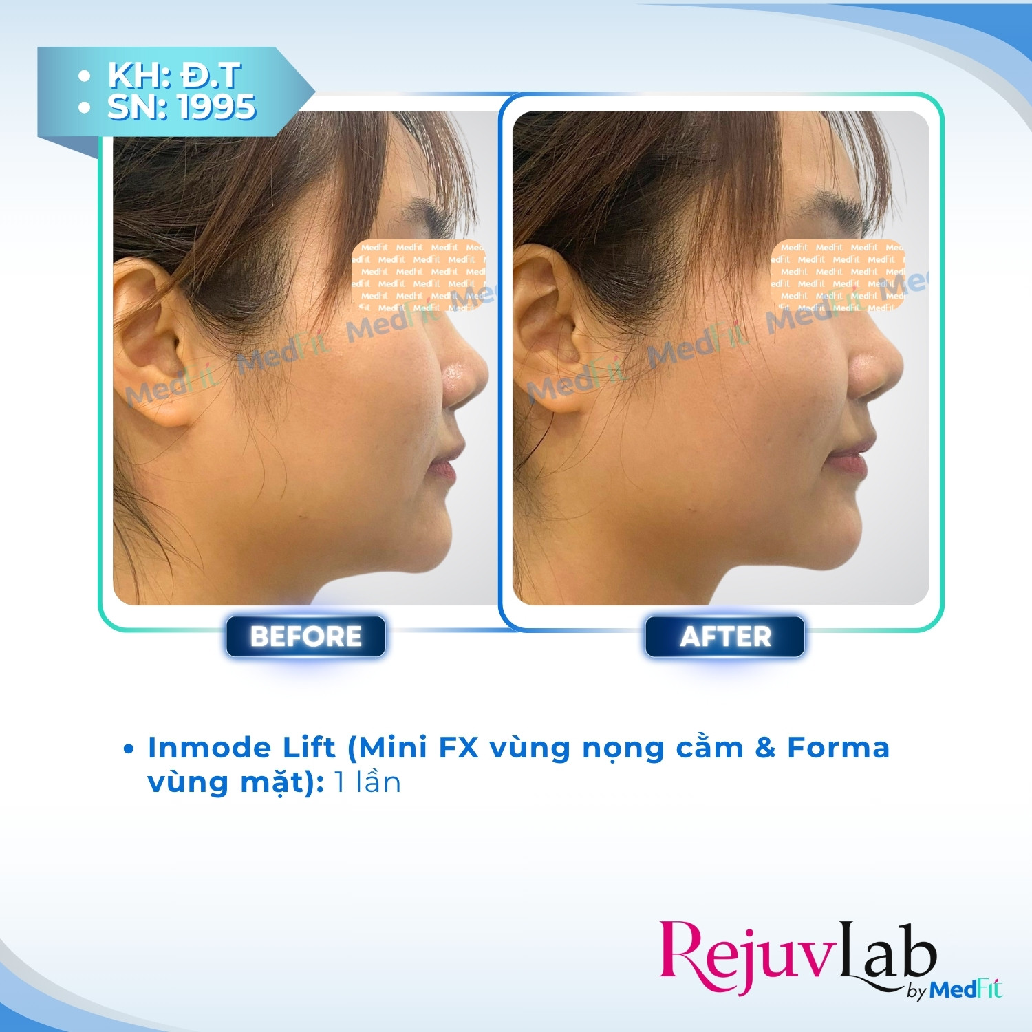 Giảm mỡ vùng mặt - trị nọng cằm 15
