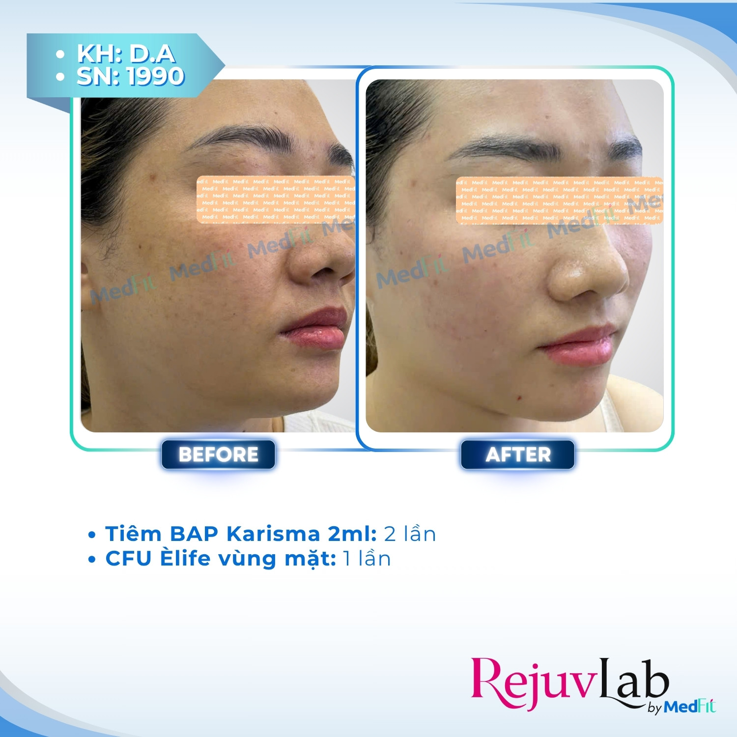 Nâng cơ và trẻ hóa da - căn chỉnh khuôn mặt 77