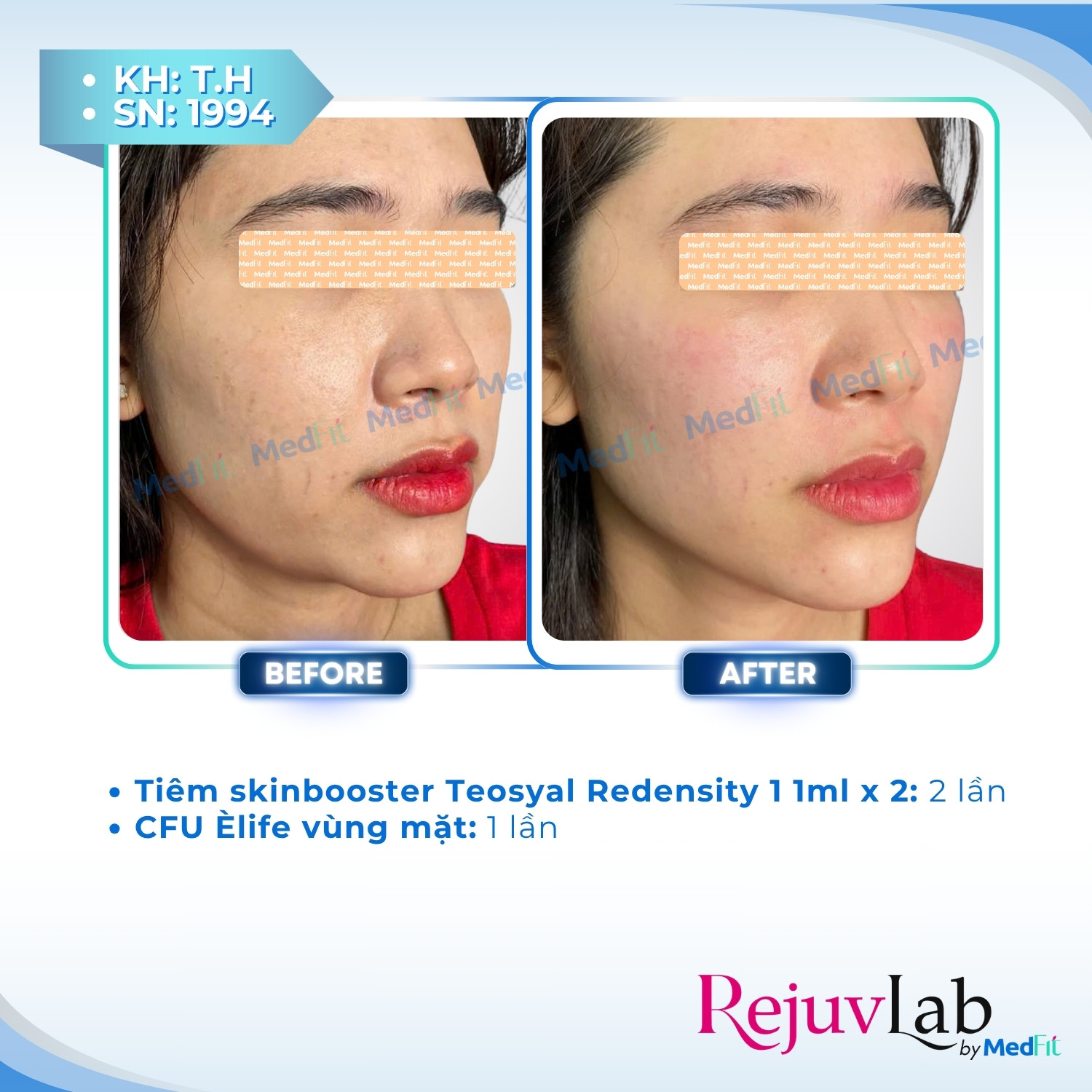 Nâng cơ và trẻ hóa da - căn chỉnh khuôn mặt 79