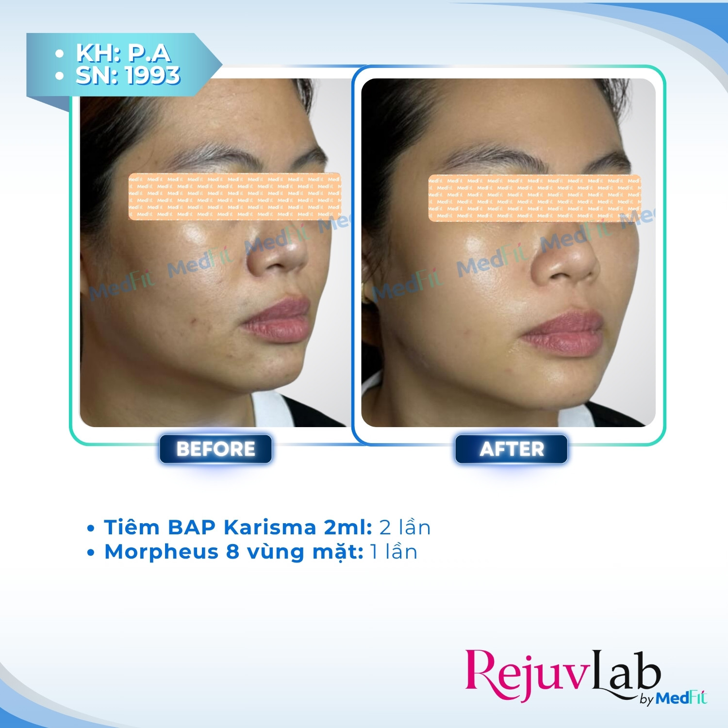 KARISMA – Bước tiến đột phá trong thẫm mỹ - Trẻ hóa da vượt trội với Collagen tái tổ hợp 5