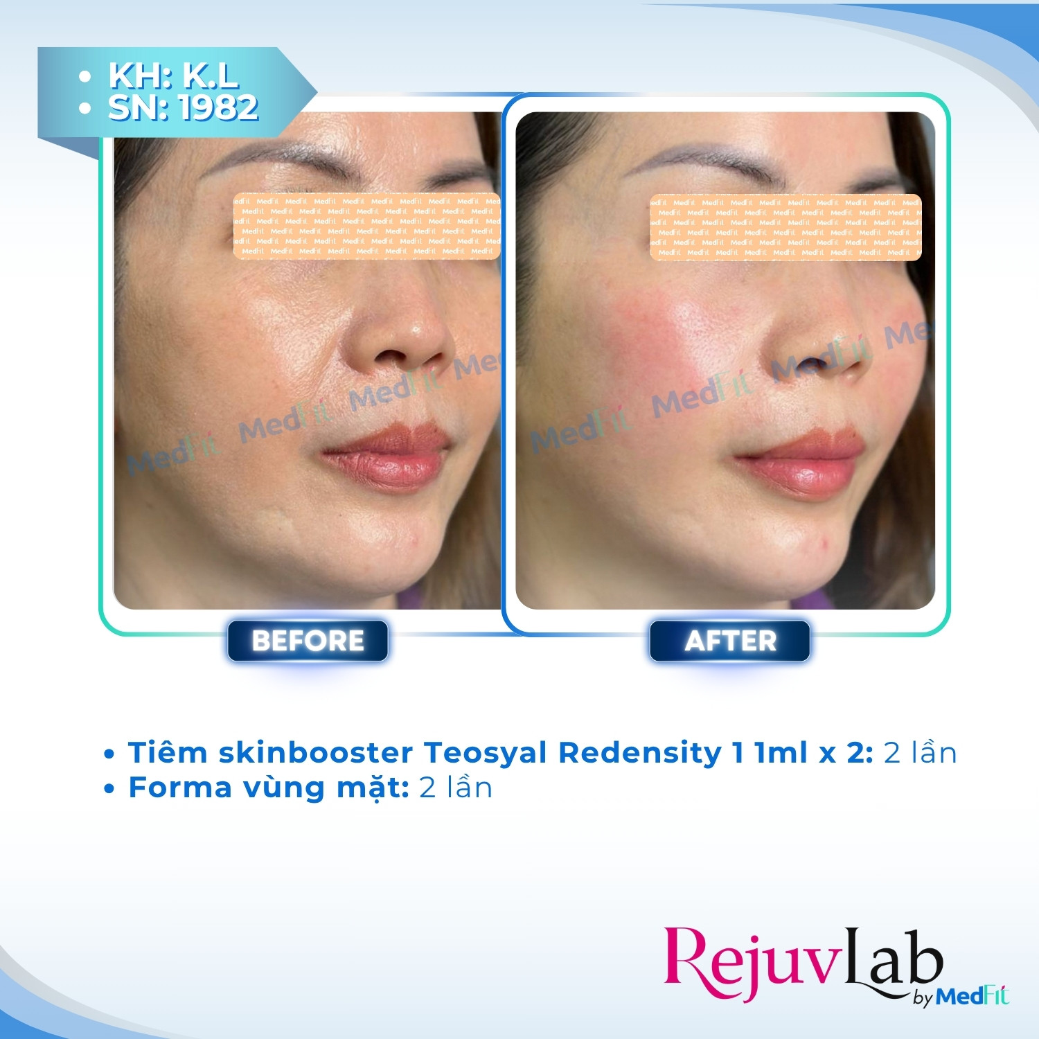 Teosyal® Puresense Redensity 1 – Liệu pháp trẻ hóa da với hyaluronic acid đến từ Teoxane – Thụy Sĩ 4