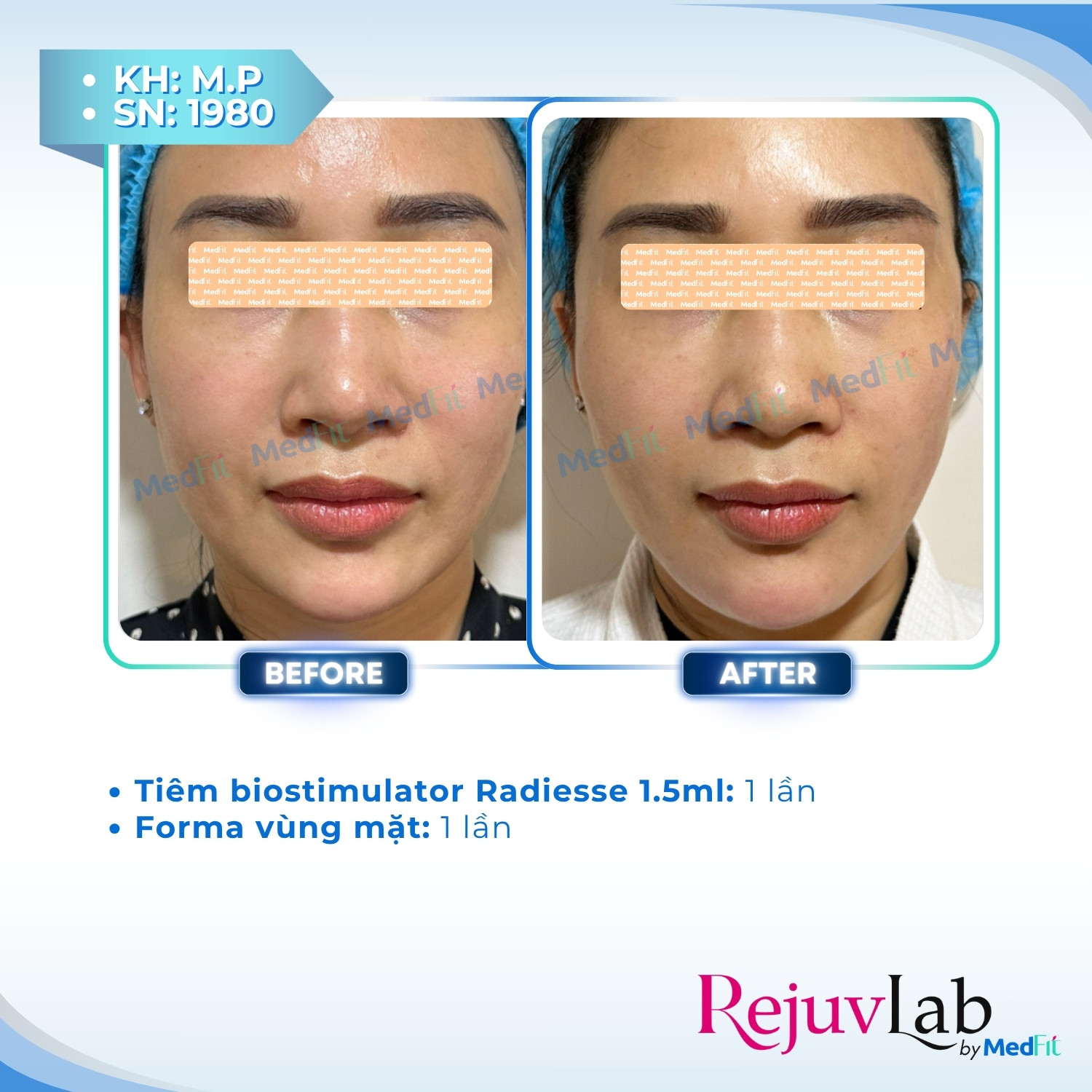 Radiesse – Tái tạo làn da và lấy lại nét đẹp tươi trẻ 5