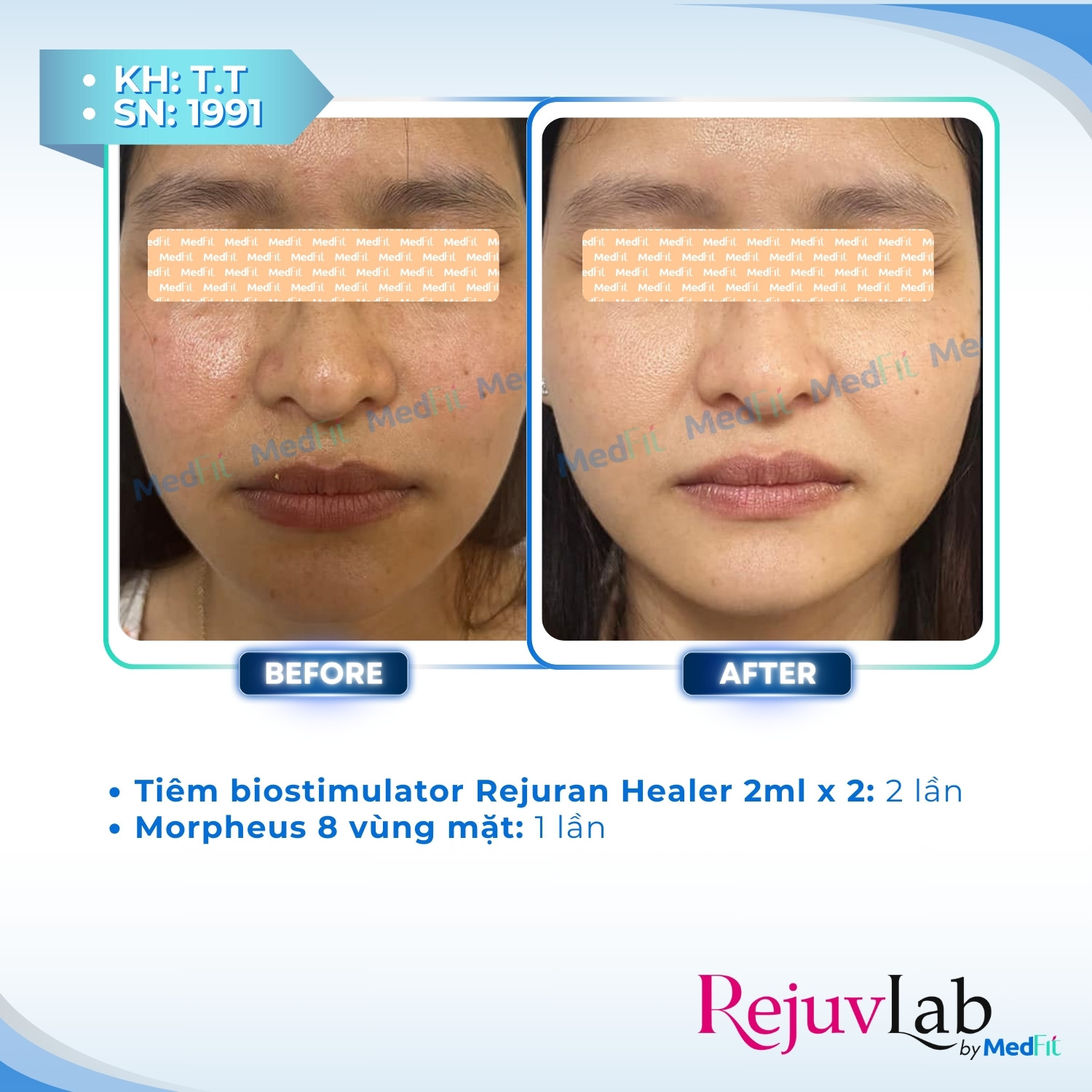 Rejuran Healer – Giải pháp trẻ hóa và tái tạo, phục hồi làn da 12