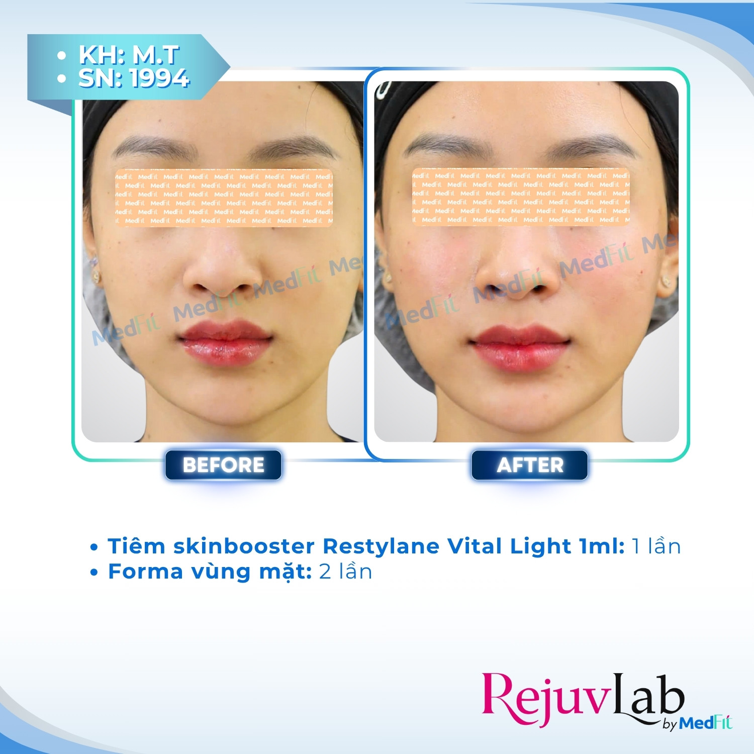 Restylane Vital Light – Tái tạo độ ẩm, cải thiện cấu trúc và trẻ hóa da tự nhiên 4