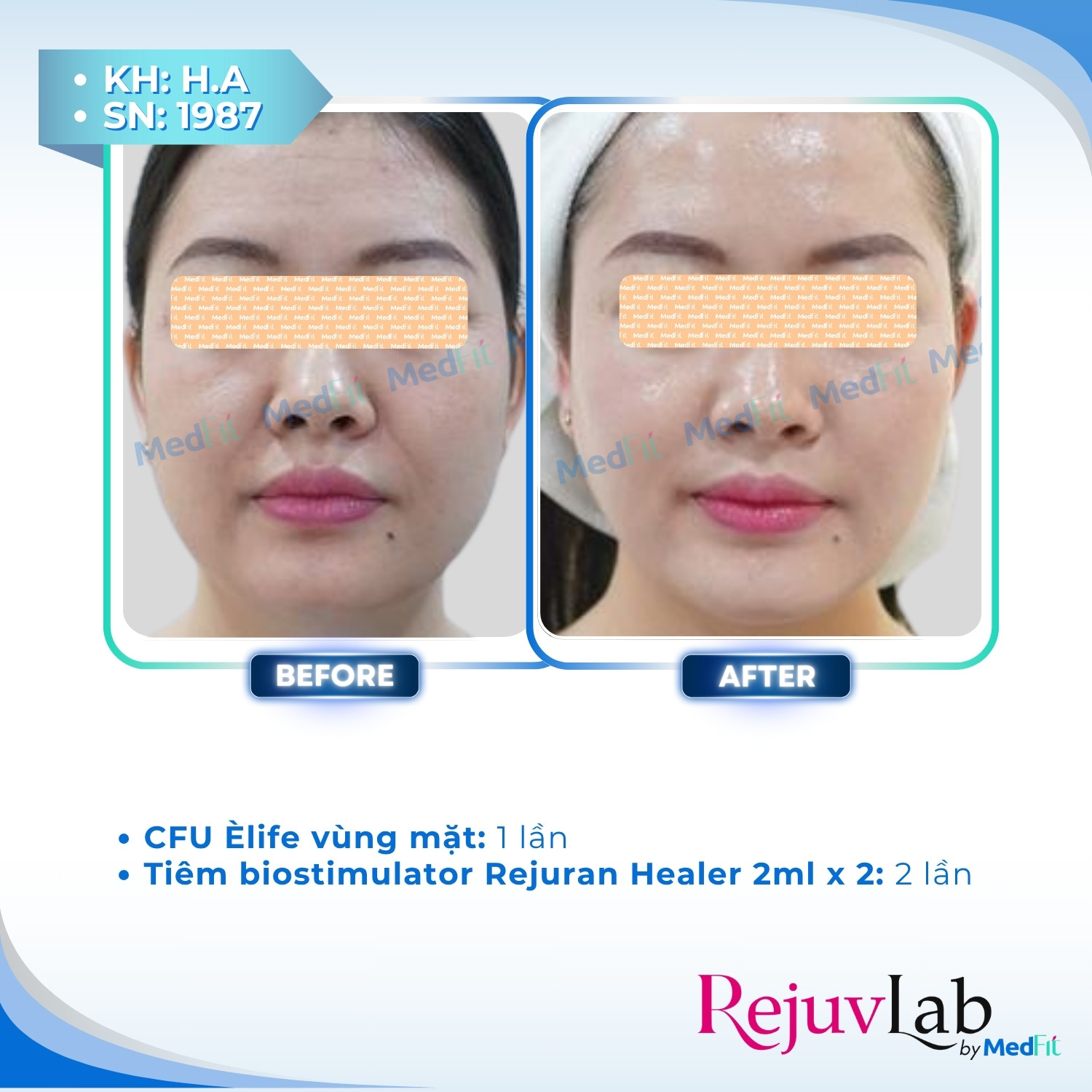 Nâng cơ và trẻ hóa da - căn chỉnh khuôn mặt 65