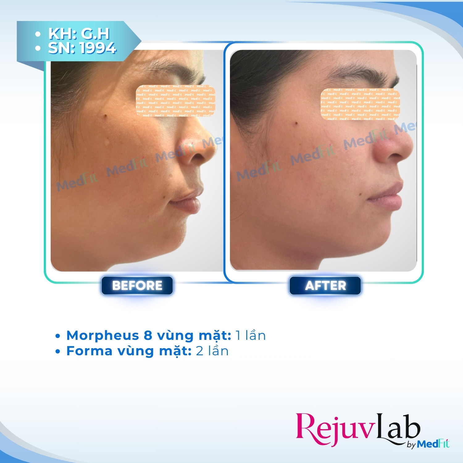 Morpheus8 - Công nghệ đỉnh cao giúp giảm mỡ mặt và trẻ hóa làn da 6