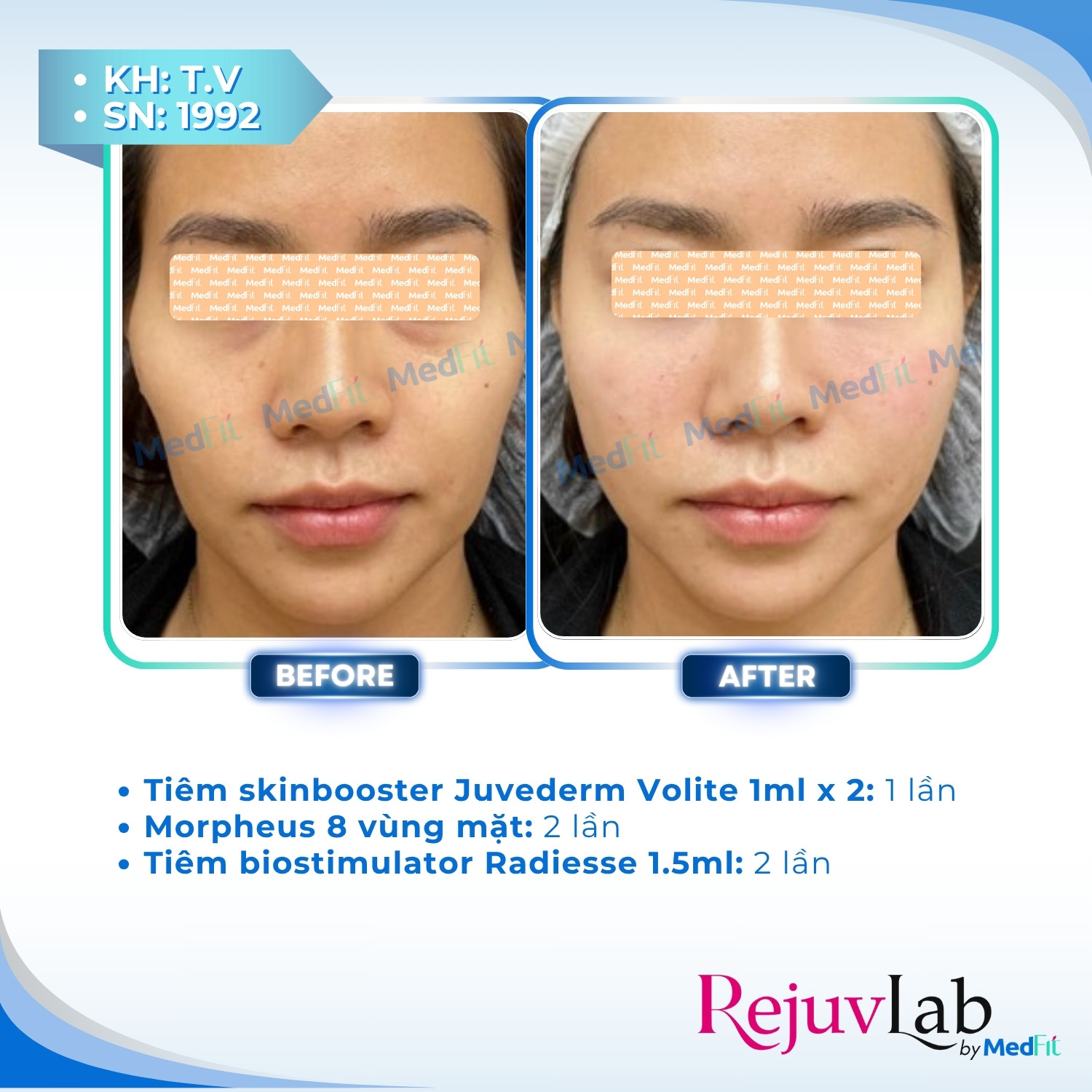 Juvederm® Volite – Kiến tạo khuôn mặt tươi trẻ và sắc nét 4