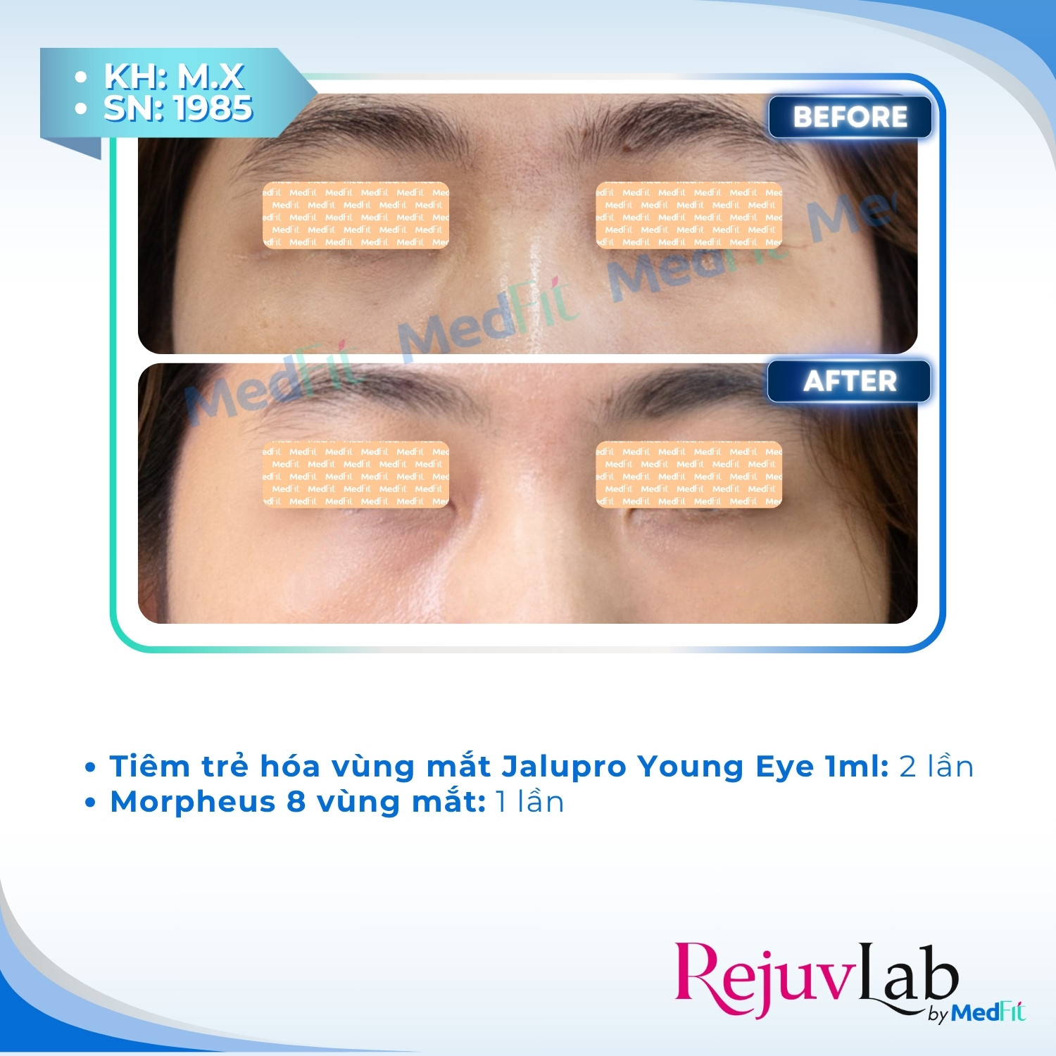 Jalupro Young EYE - Giải pháp trẻ hóa toàn diện cho vùng mắt 4