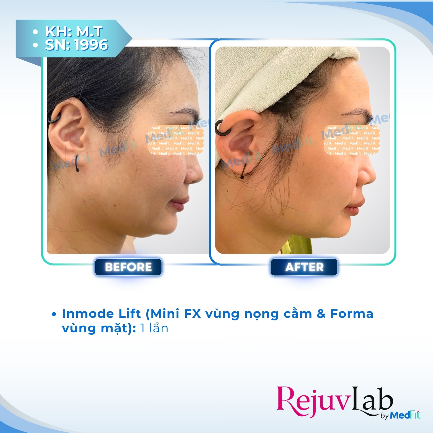 InMode Lift – Giải pháp nâng cơ và giảm mỡ mặt không phẫu thuật 5