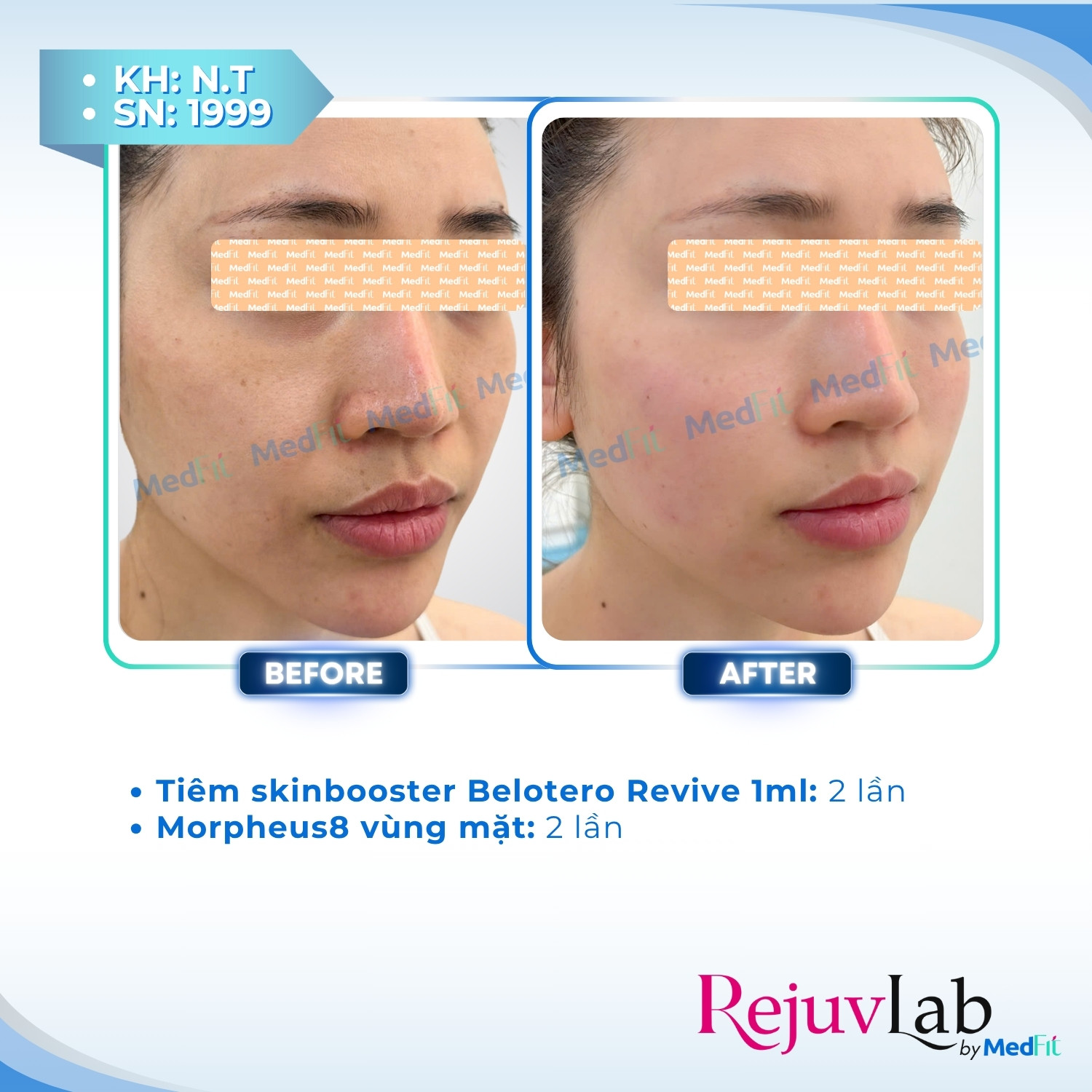 Belotero Revive - Công nghệ tái sinh làn da hoàn hảo 4