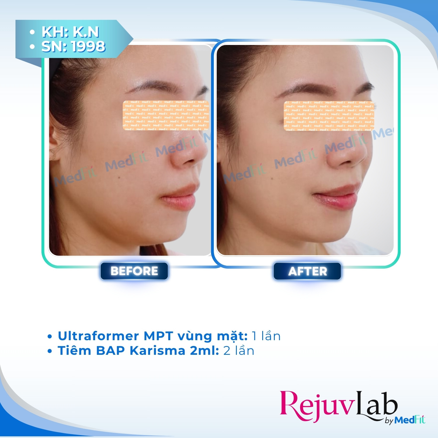 Ultraformer MPT – Đột phá mới trong công nghệ : nâng cơ, giảm mỡ, trẻ hóa da toàn diện 5
