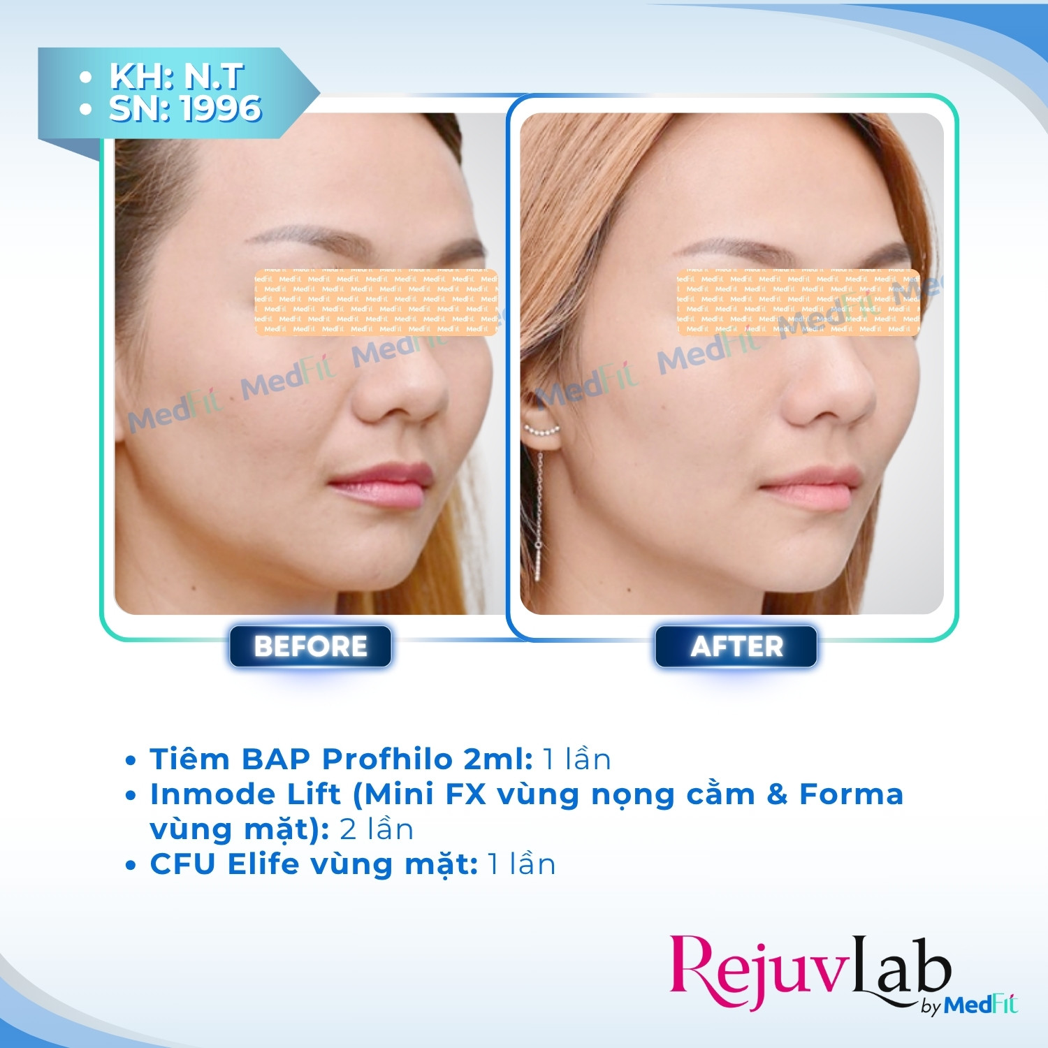 Tiêm B.A.P Profhilo - Phương pháp cấp ẩm và trẻ hóa da với hyaluronic acid 6