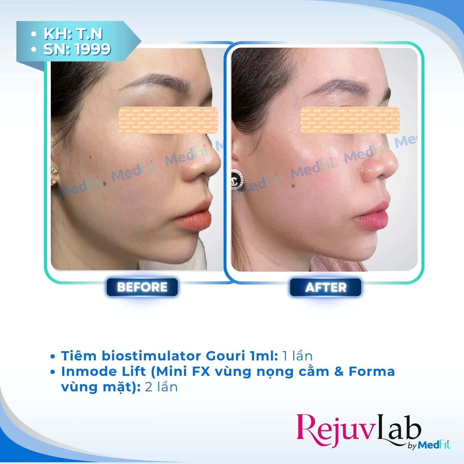 Gouri - Công nghệ kích thích sinh học tiên tiến PCL dạng lỏng 6