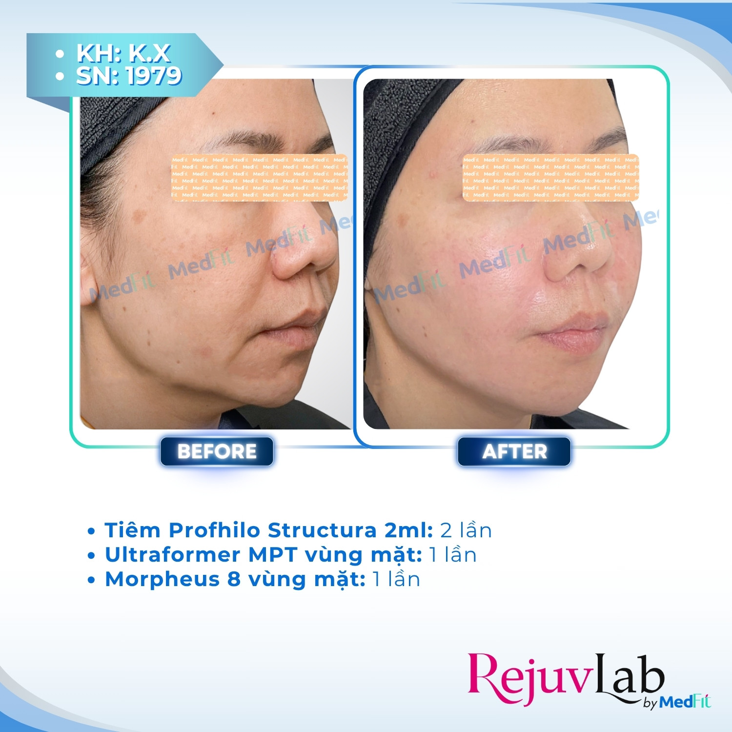 Profhilo Structura – Phương pháp cấp ẩm và trẻ hóa mô mỡ với hyaluronic acid 10