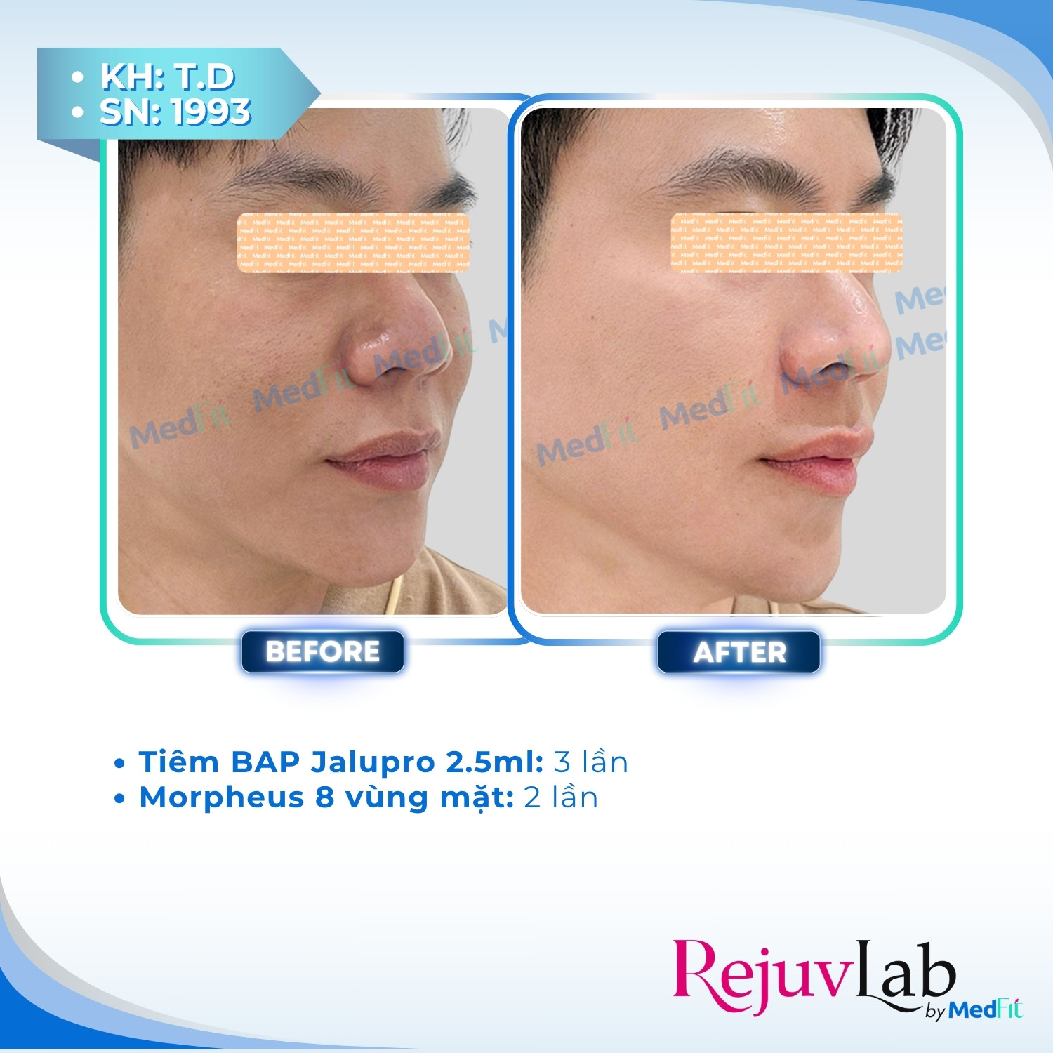 Tiêm B.A.P Jalupro – Phương pháp cấp ẩm và trẻ hóa, tái sinh làn da rạng ngời 5
