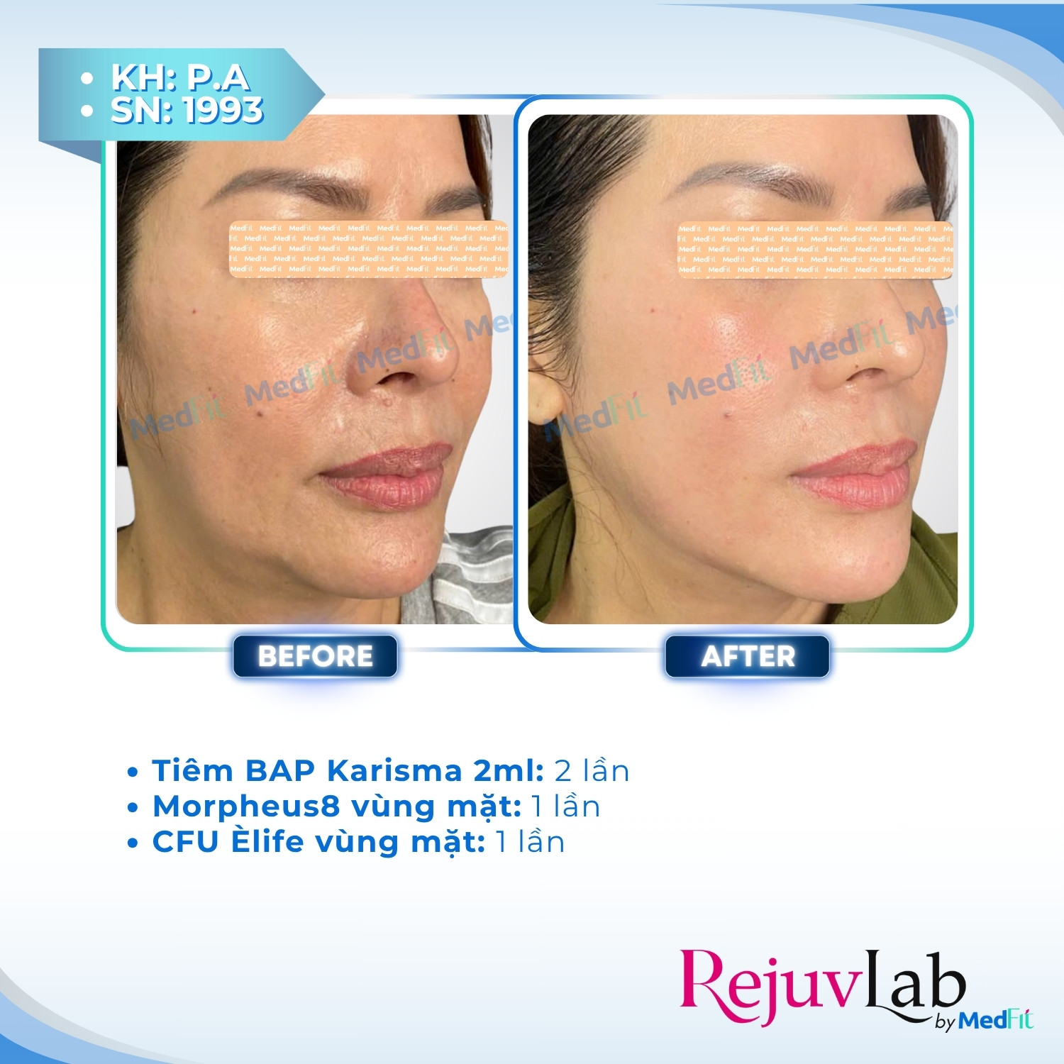 KARISMA – Bước tiến đột phá trong thẫm mỹ - Trẻ hóa da vượt trội với Collagen tái tổ hợp 6