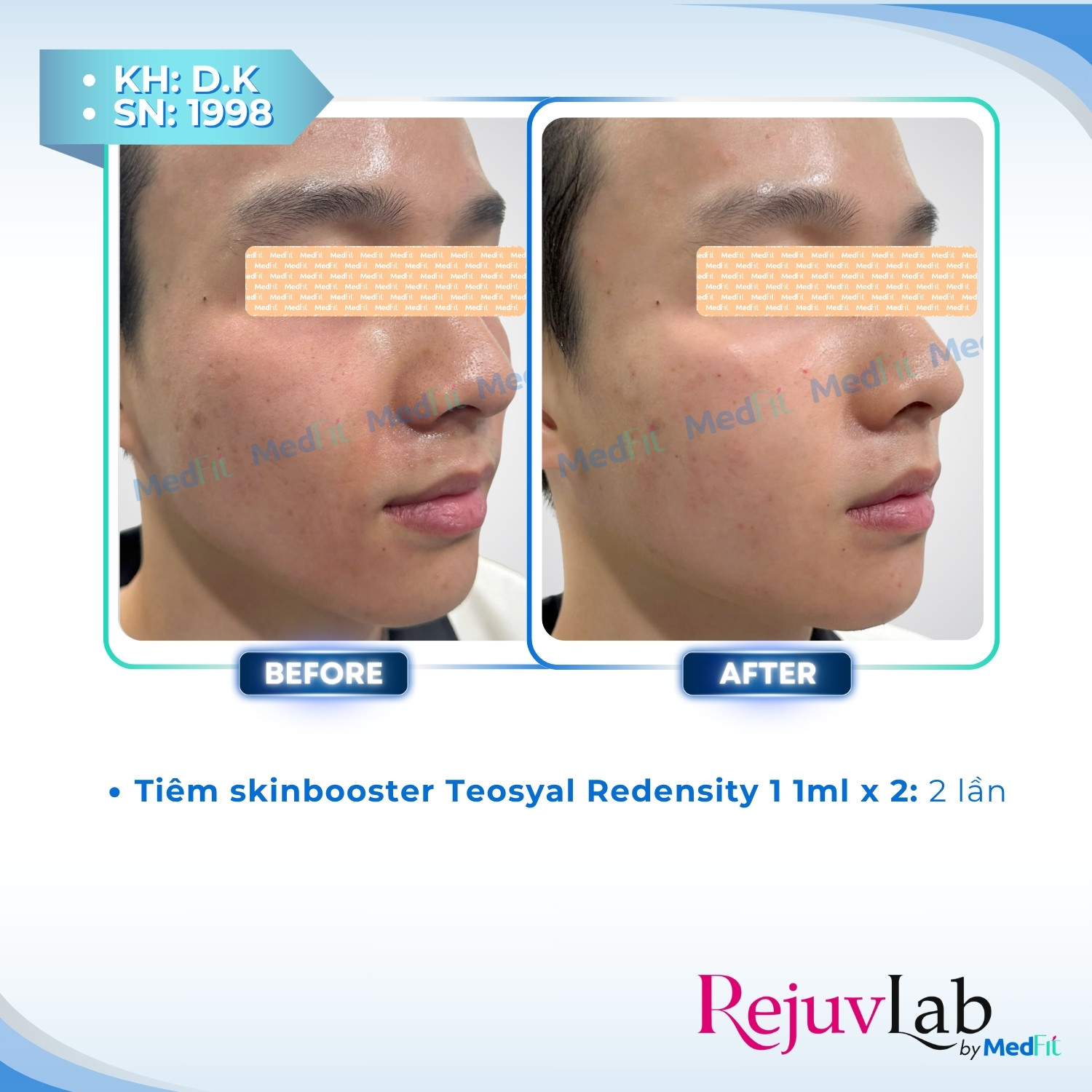 Teosyal® Puresense Redensity 1 – Liệu pháp trẻ hóa da với hyaluronic acid đến từ Teoxane – Thụy Sĩ 5