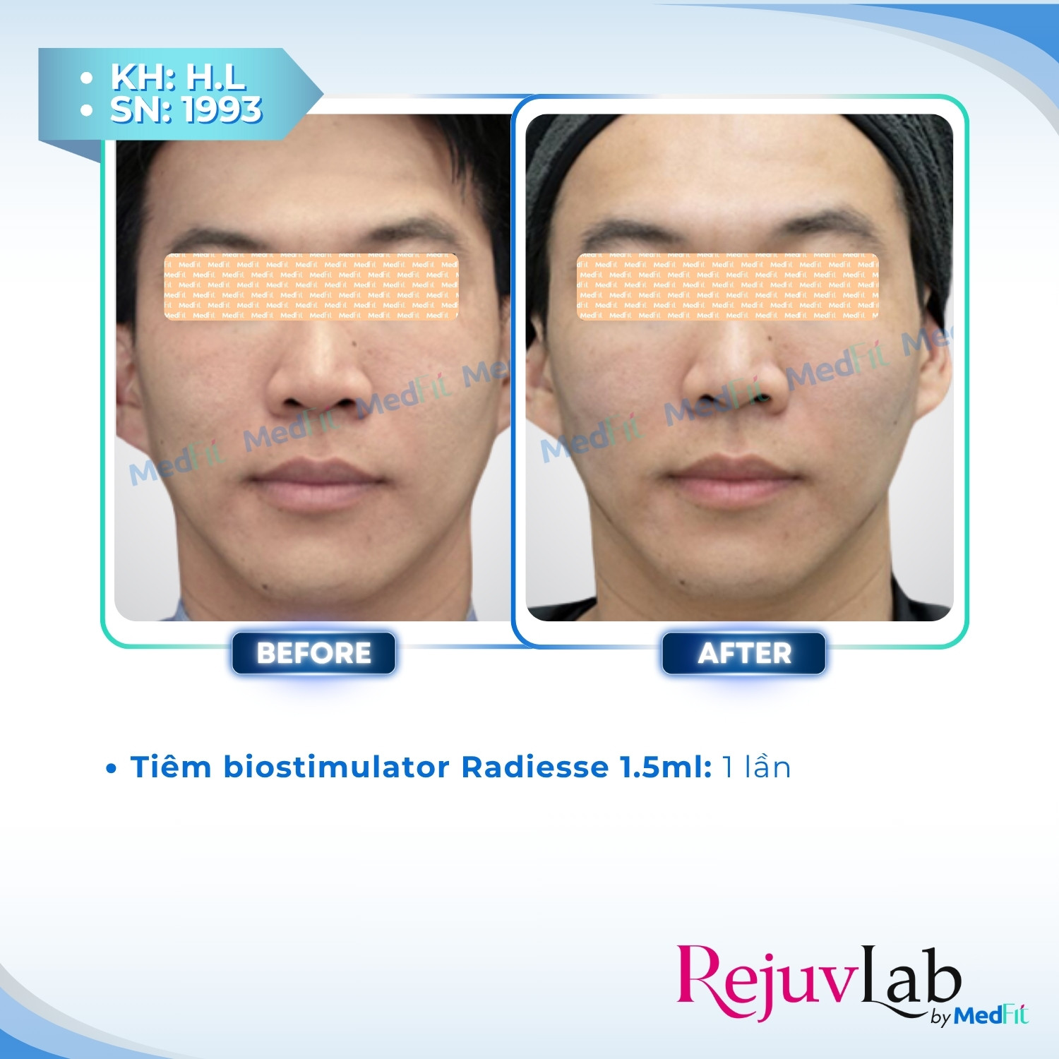 Radiesse – Tái tạo làn da và lấy lại nét đẹp tươi trẻ 6