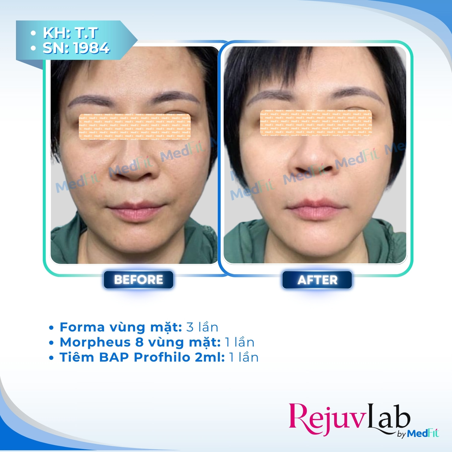 Forma - Công nghệ nâng cơ và làm săn chắc da không xâm lấn 4