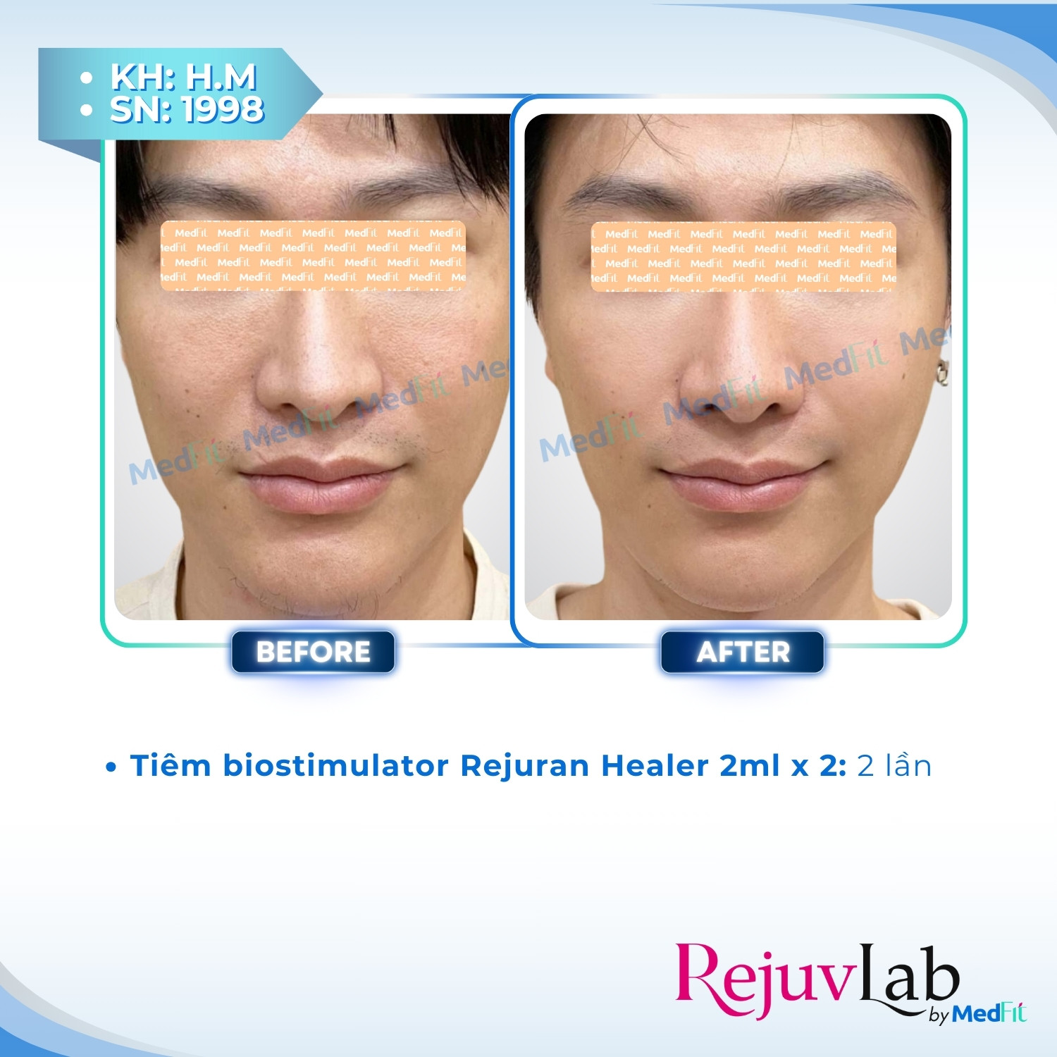 Rejuran Healer – Giải pháp trẻ hóa và tái tạo, phục hồi làn da 13