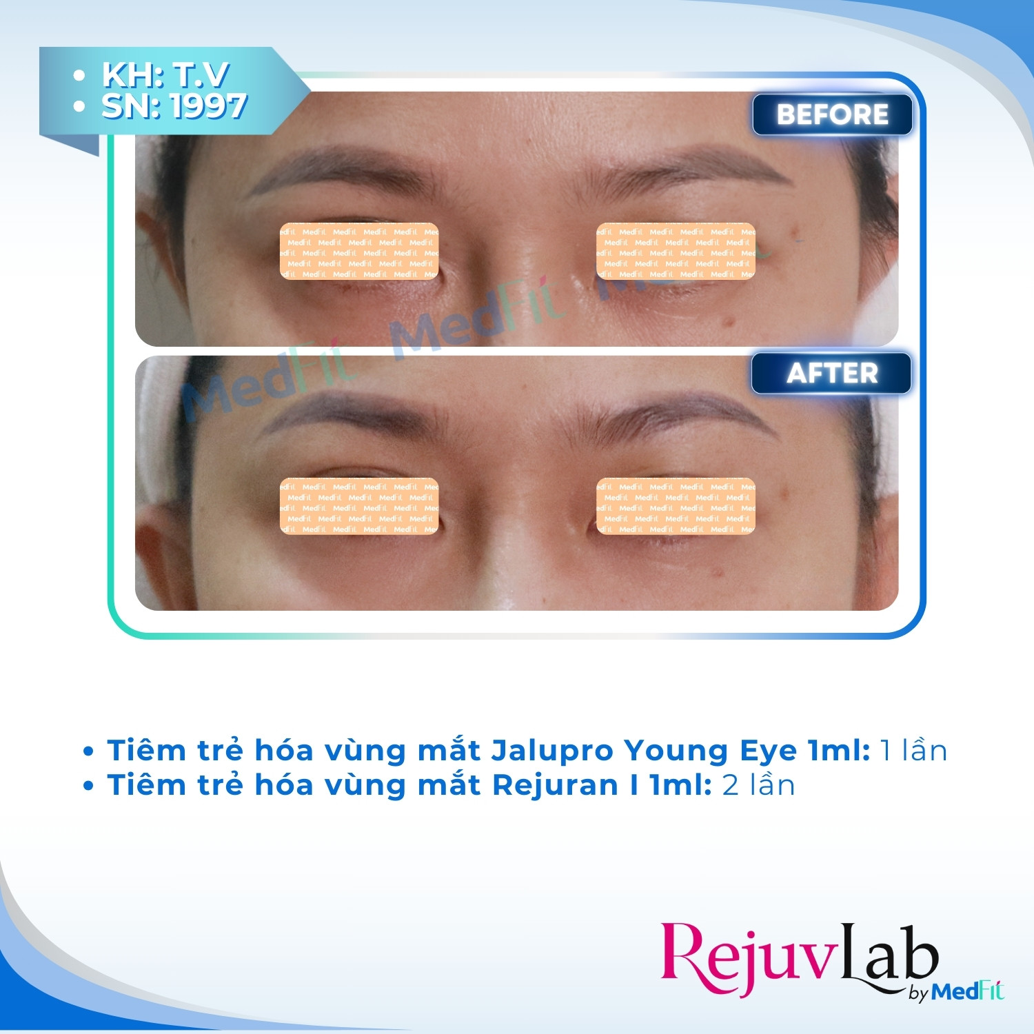 Trẻ hóa vùng mắt 7