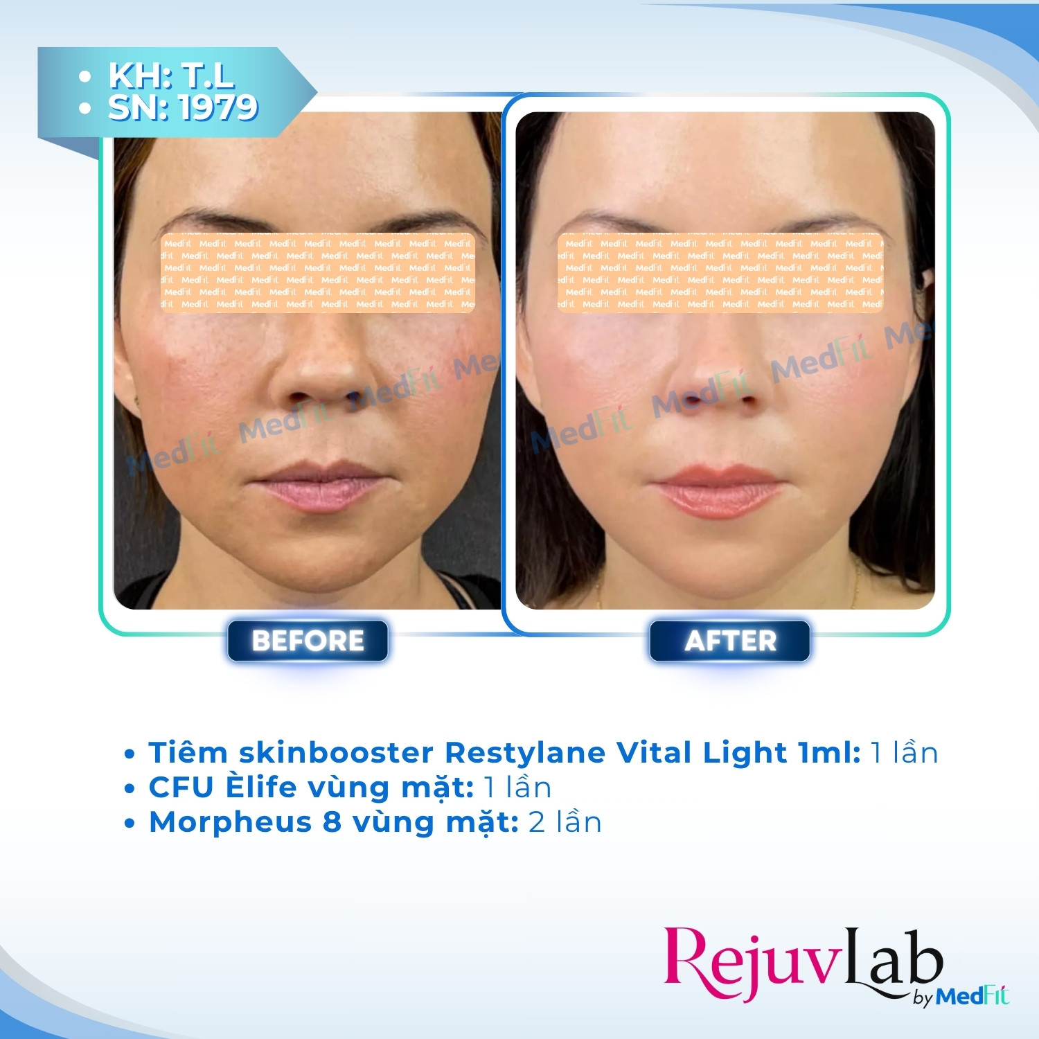 Restylane Vital Light – Tái tạo độ ẩm, cải thiện cấu trúc và trẻ hóa da tự nhiên 5