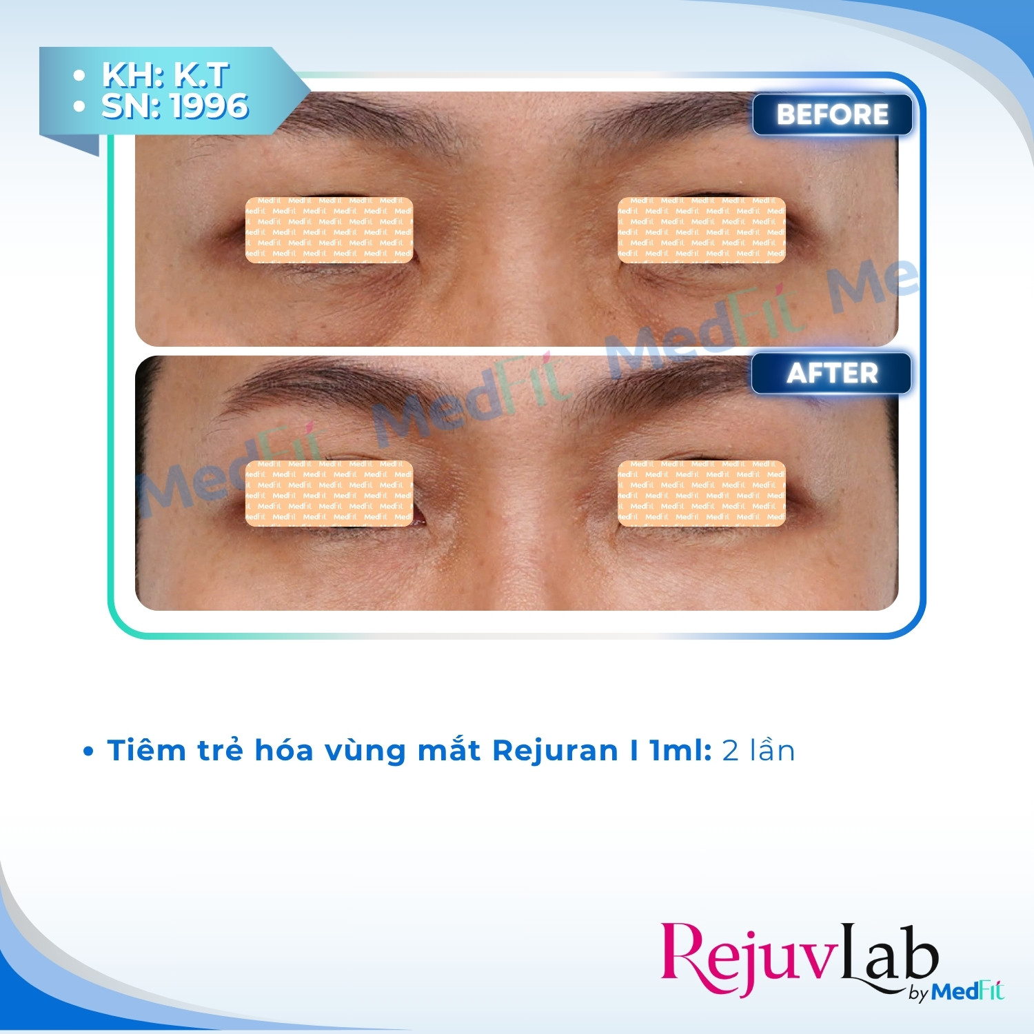 Rejuran i – Giải pháp trẻ hóa da vùng mắt 6