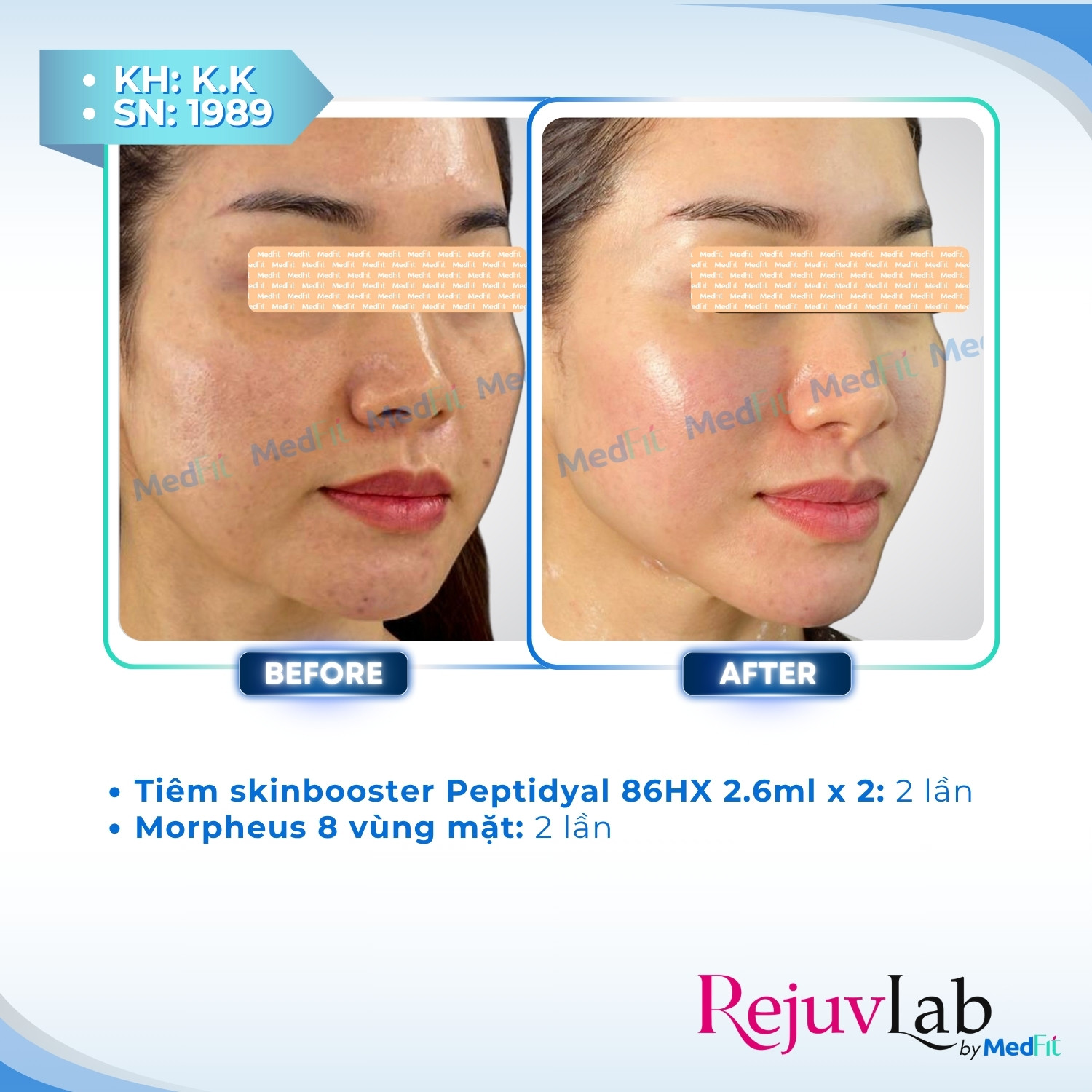 Peptidyal®86HX – Công thức tái tạo làn da tươi trẻ 5