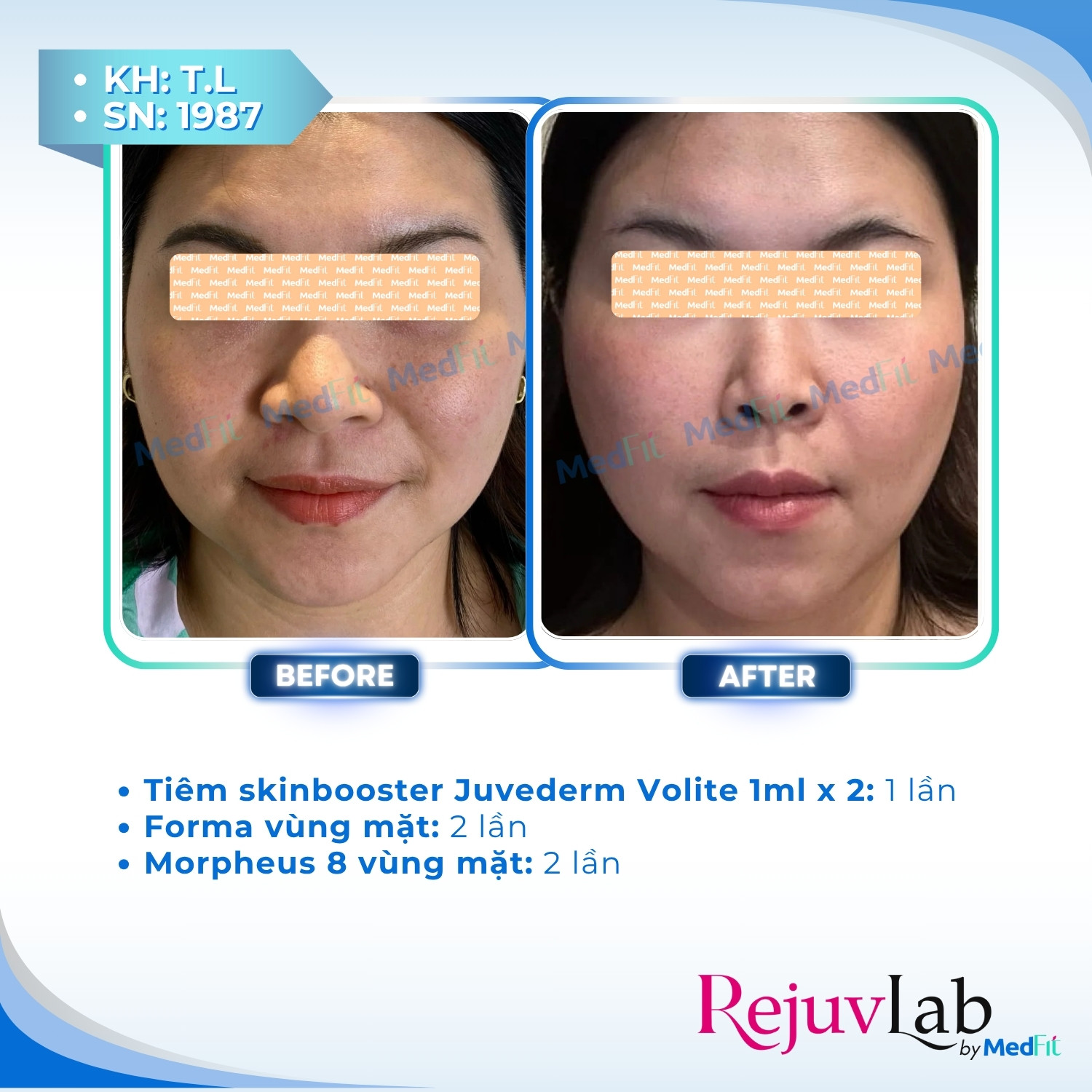 Juvederm® Volite – Kiến tạo khuôn mặt tươi trẻ và sắc nét 5