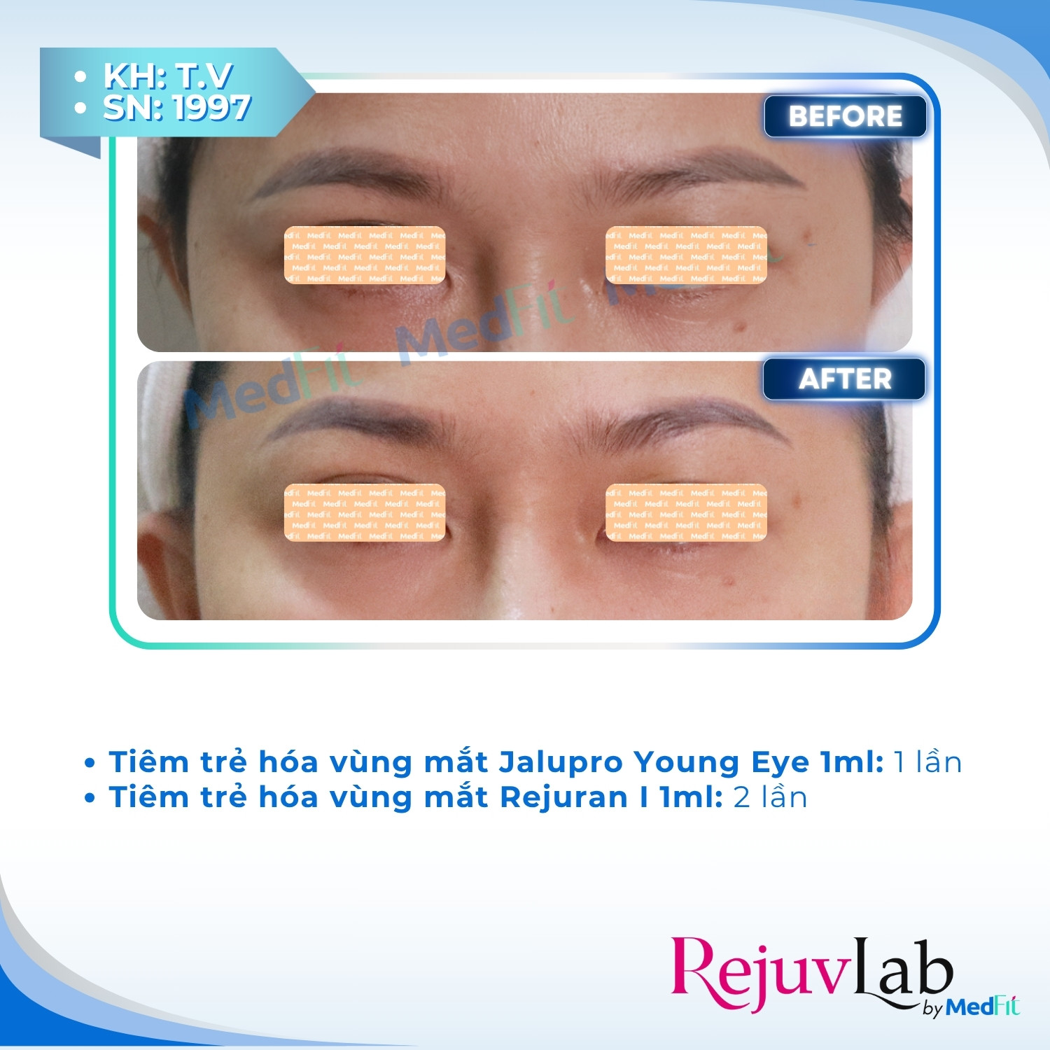 Jalupro Young EYE - Giải pháp trẻ hóa toàn diện cho vùng mắt 5